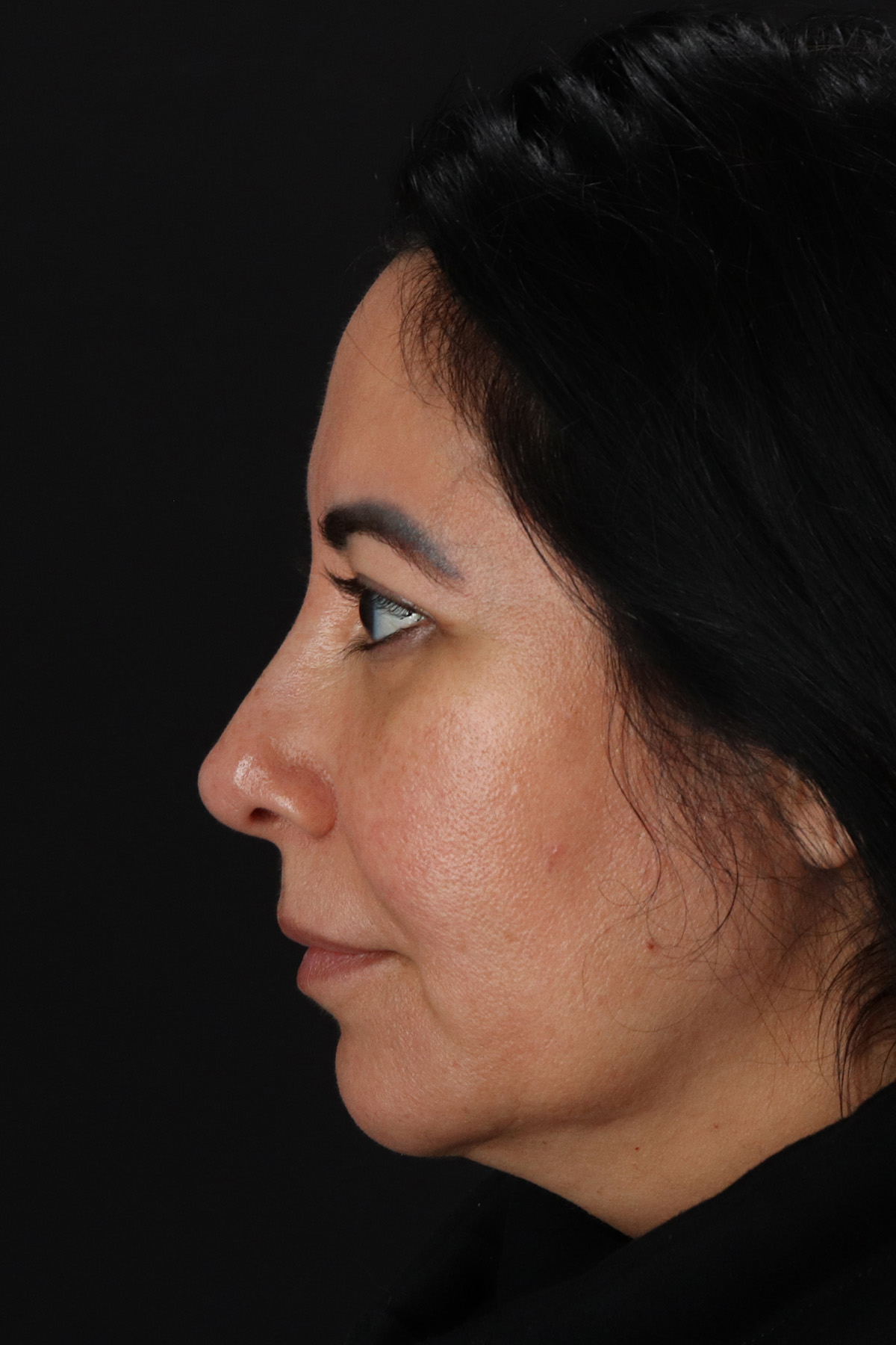 Upper Blepharoplasty Before & After Patient #12062
