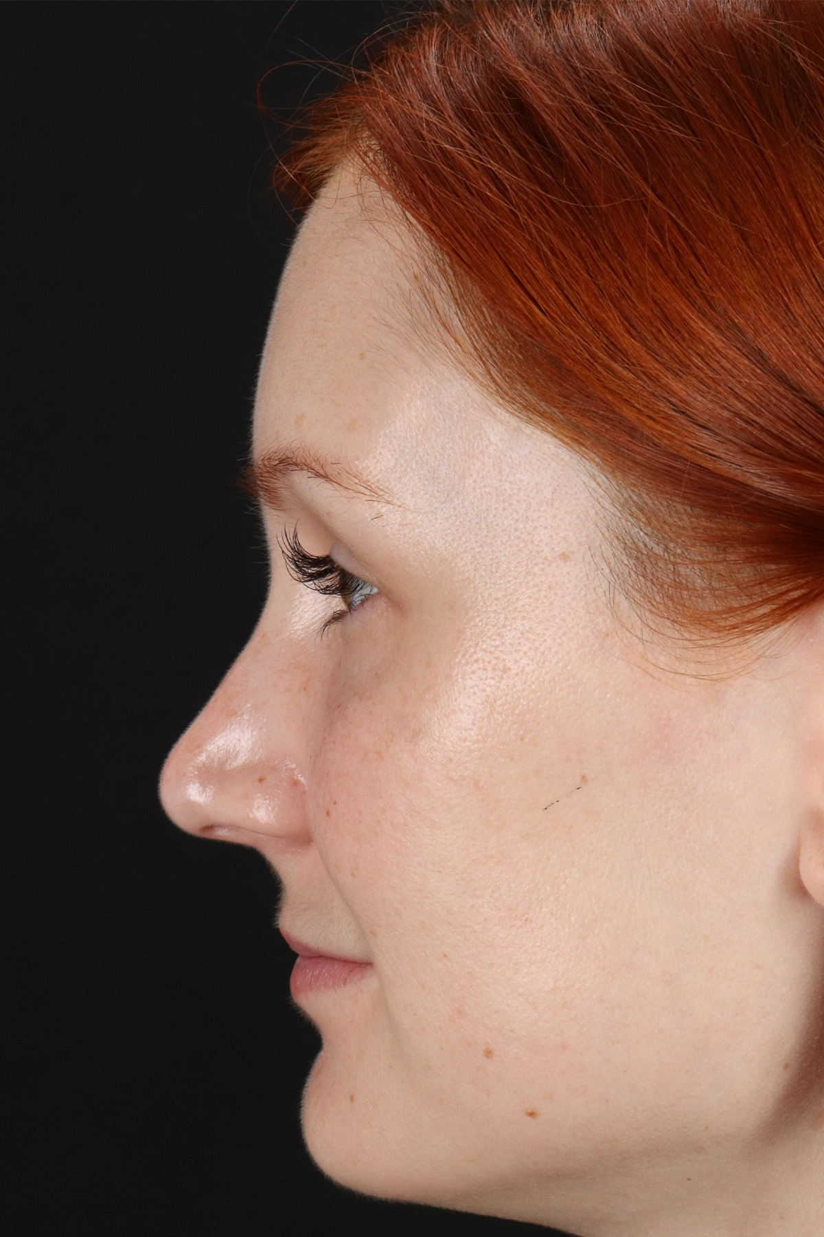 Lower Blepharoplasty Before & After Patient #13008