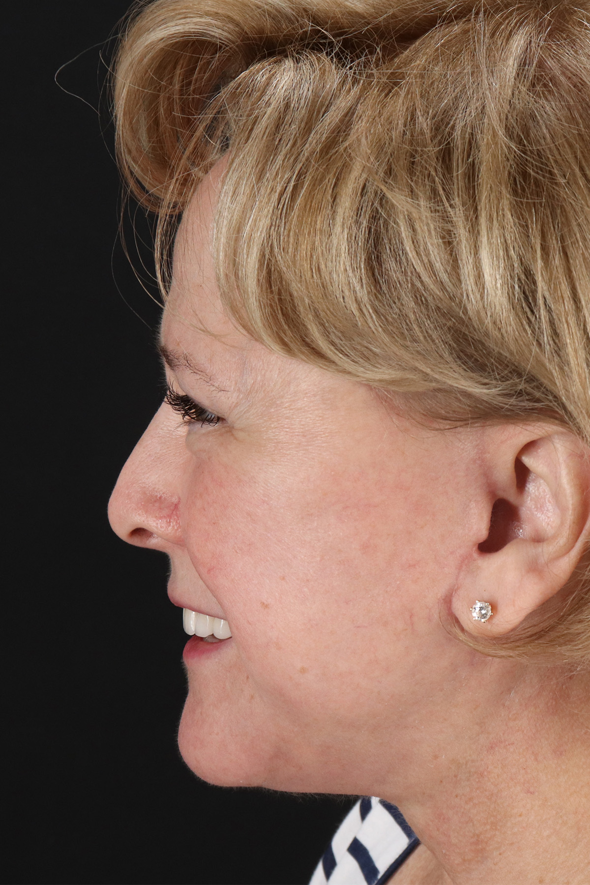 Neck Lift Before & After Patient #11696