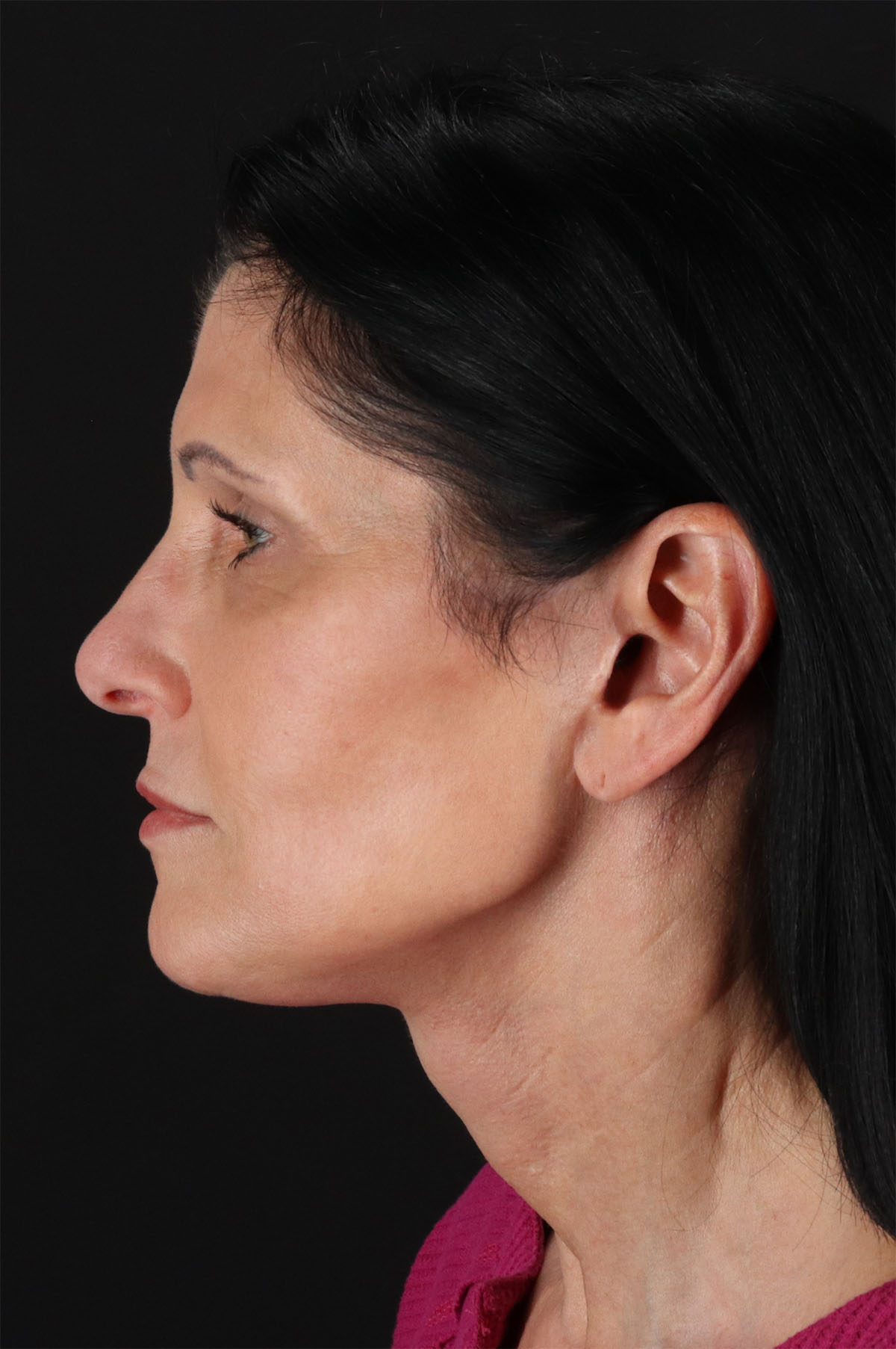 Neck Lift Before & After Patient #12887