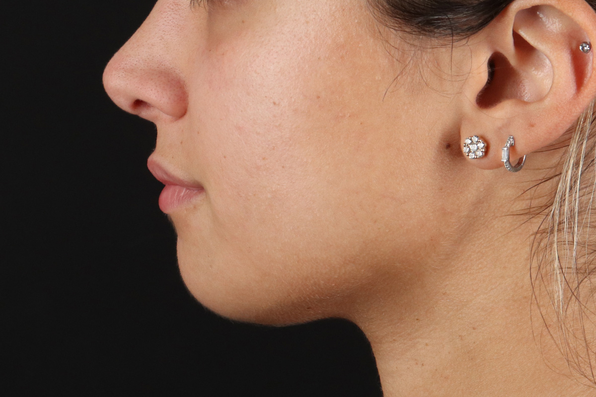 Chin Implant Before & After Patient #13750