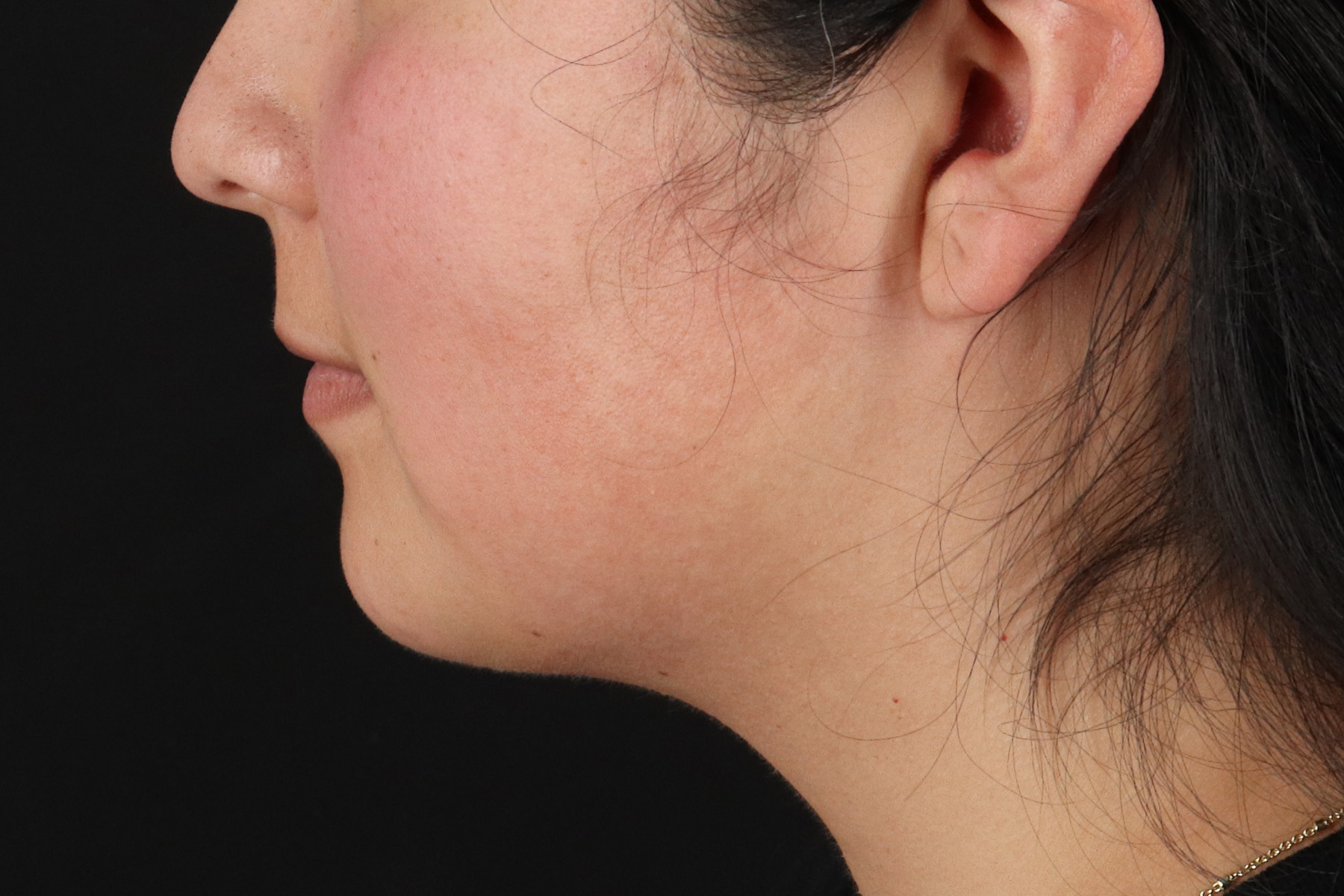Chin Implant Before & After Patient #13794
