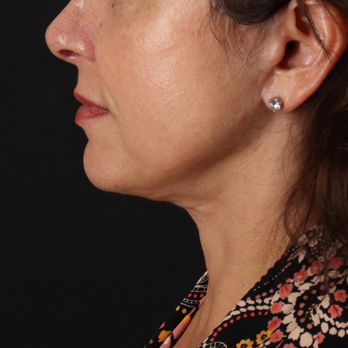 Facelift Before & After Patient #13543