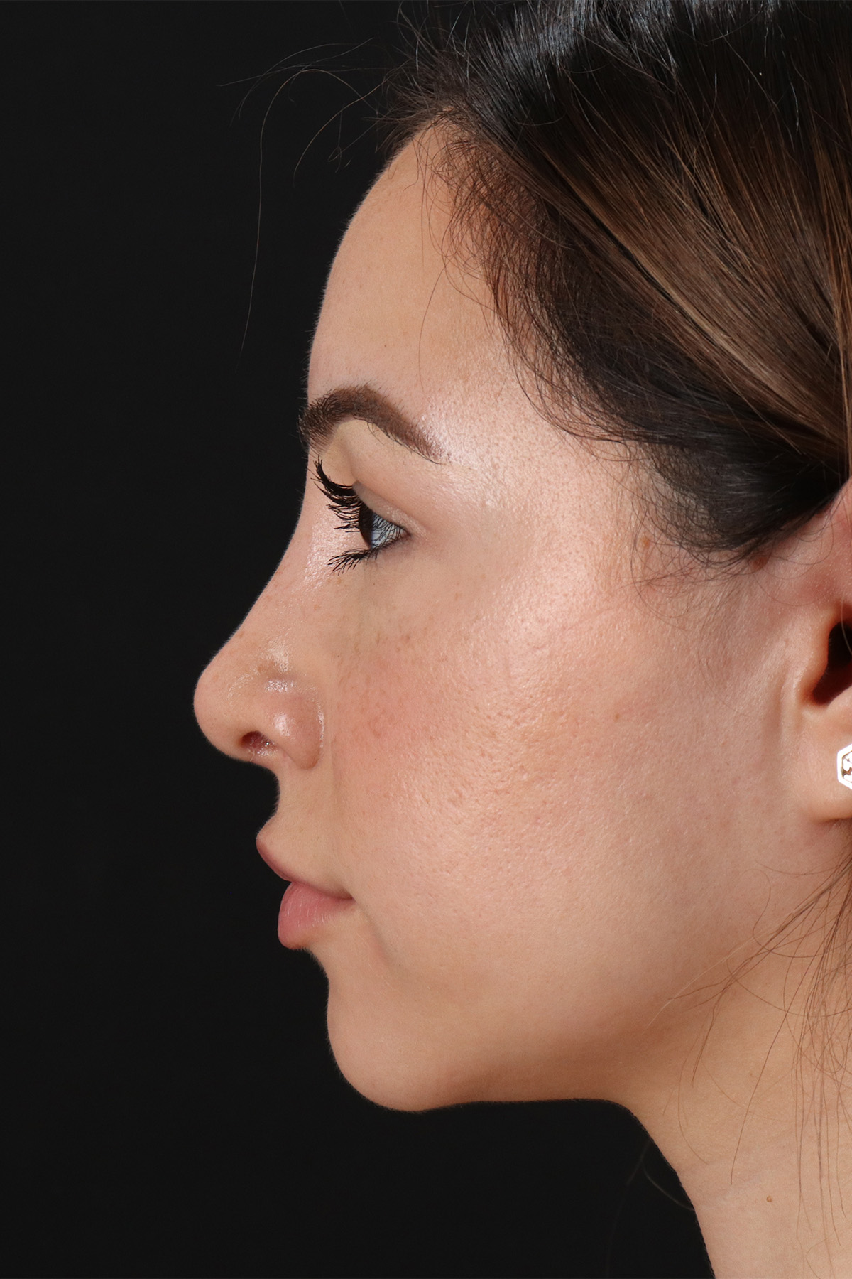 Rhinoplasty Before & After Patient #12271