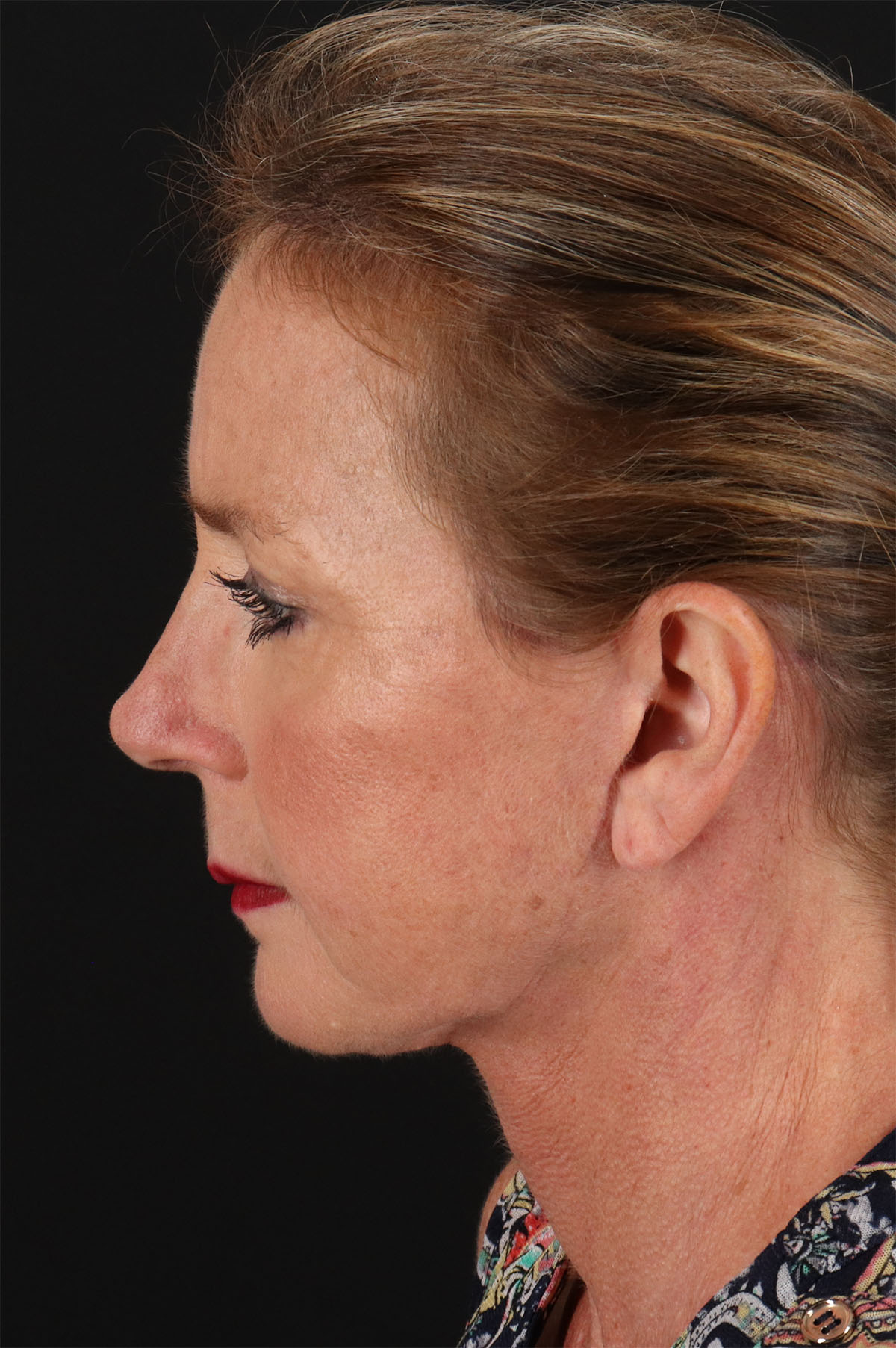 Upper Blepharoplasty Before & After Patient #12040