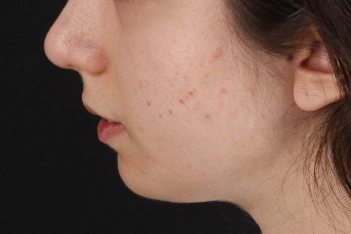 Chin Implant Before & After Patient #13772