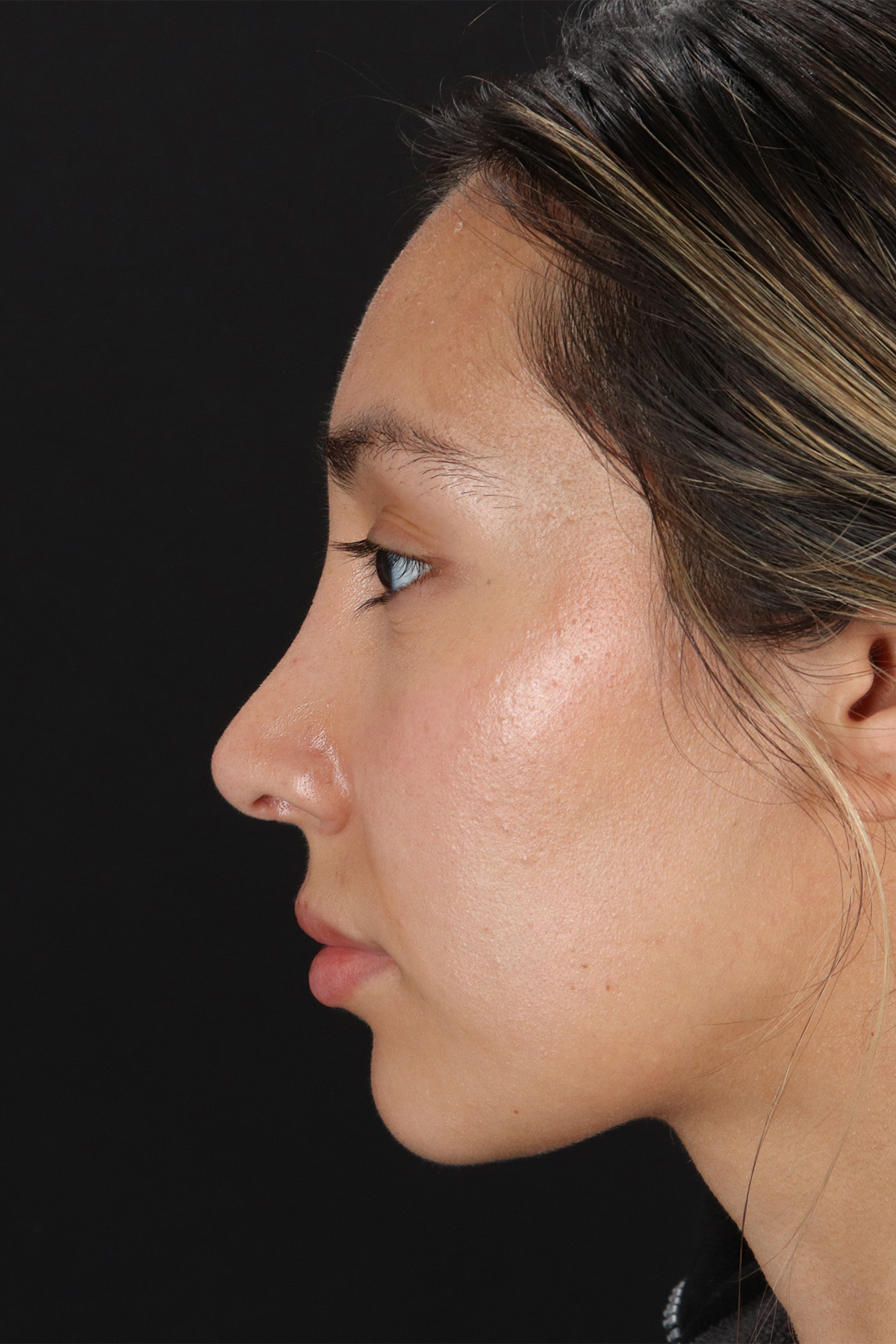 Rhinoplasty Before & After Patient #12480