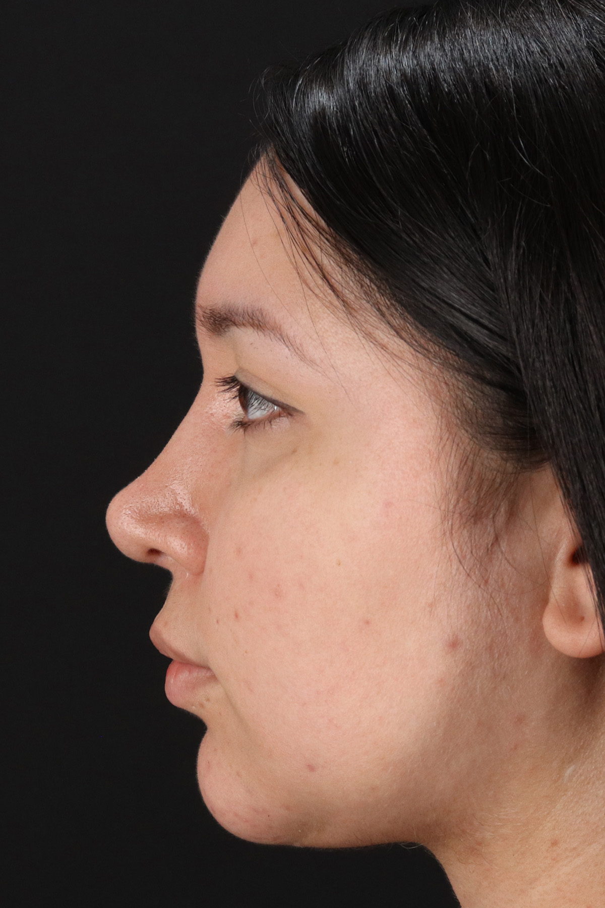 Chin Implant Before & After Patient #13739
