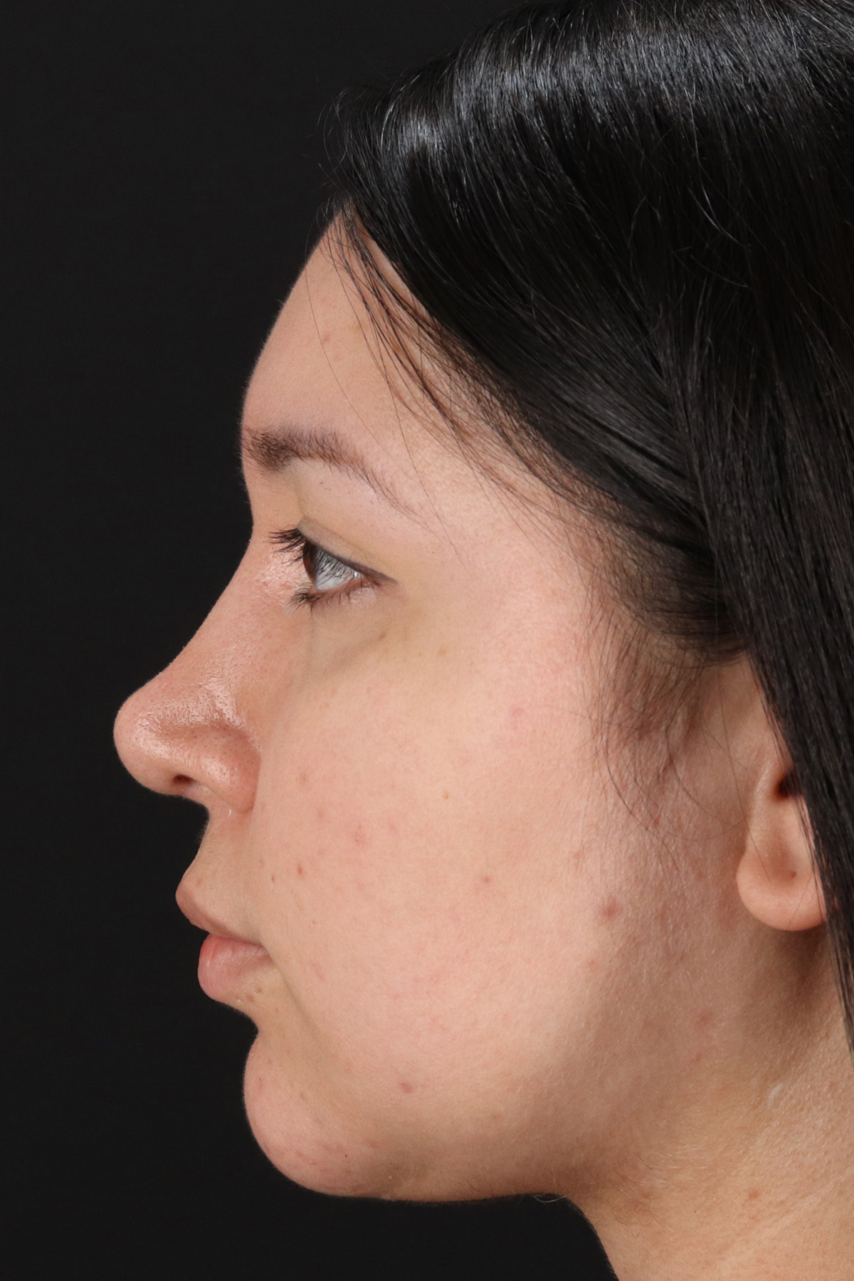 Neck Lift Before & After Patient #11698