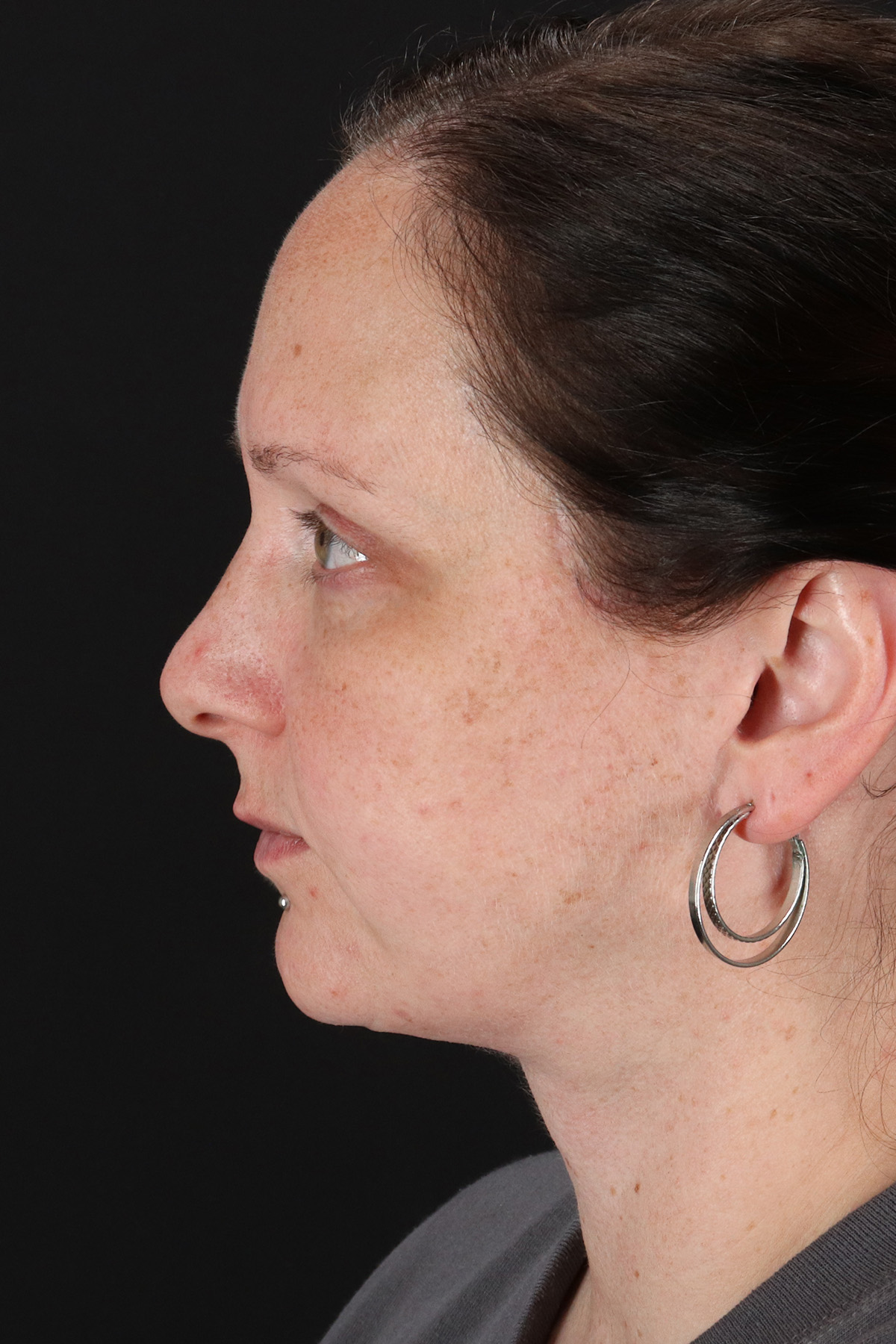 Lower Blepharoplasty Before & After Patient #13052