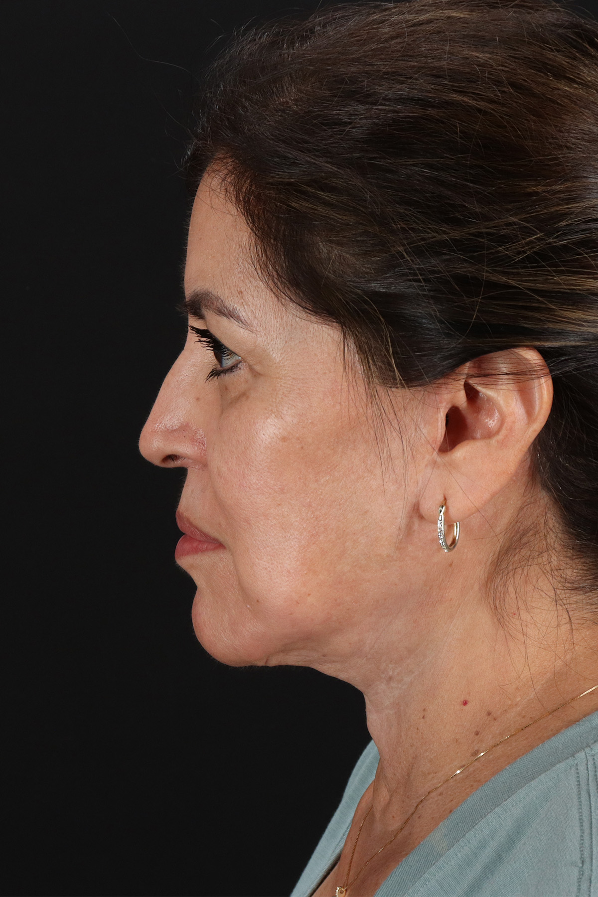 Neck Lift Before & After Patient #12909