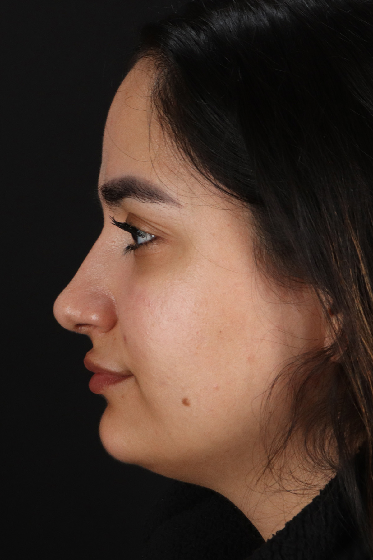 Rhinoplasty Before & After Patient #12436