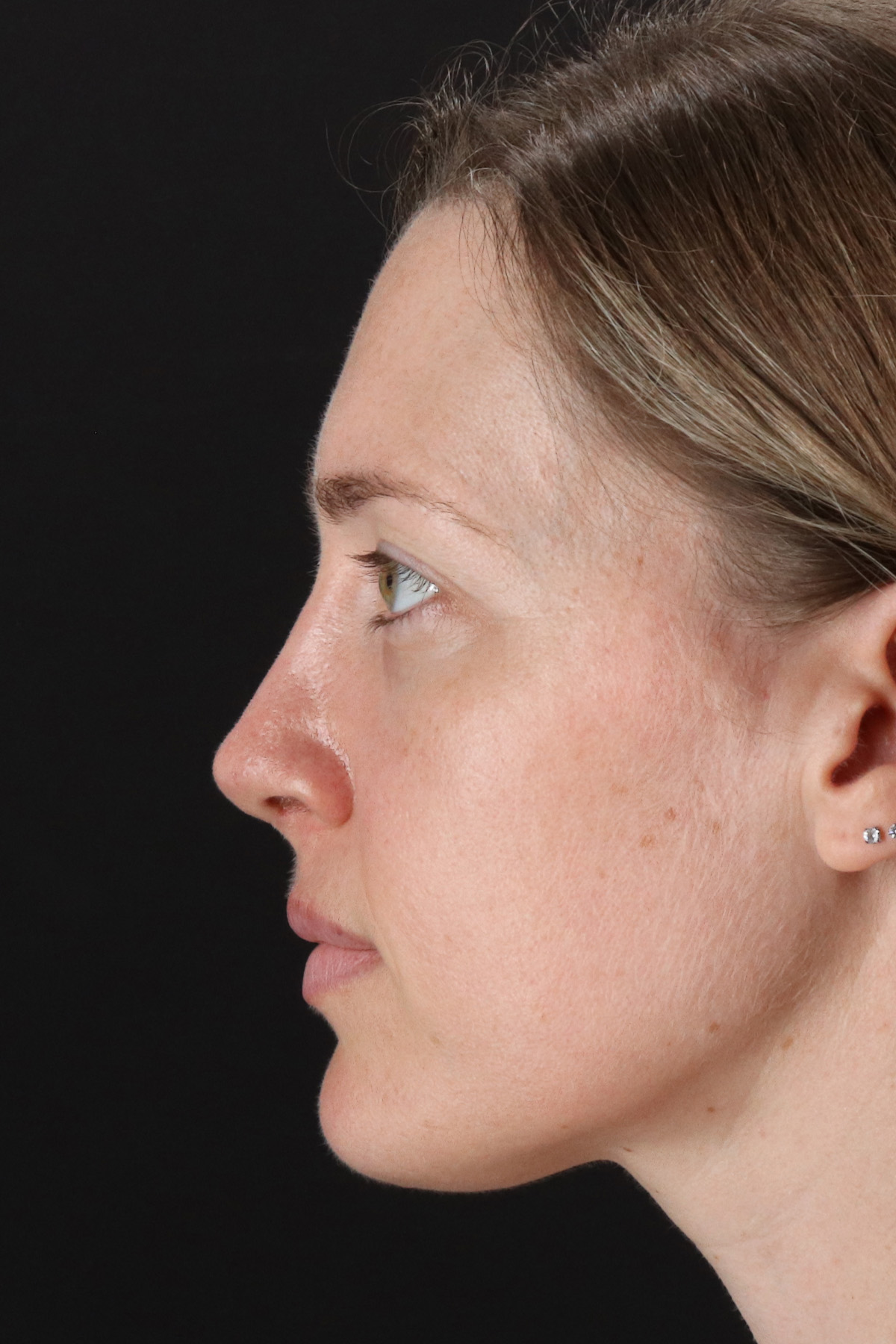 Rhinoplasty Before & After Patient #12227
