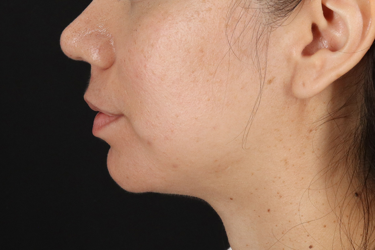 Chin Implant Before & After Patient #13783