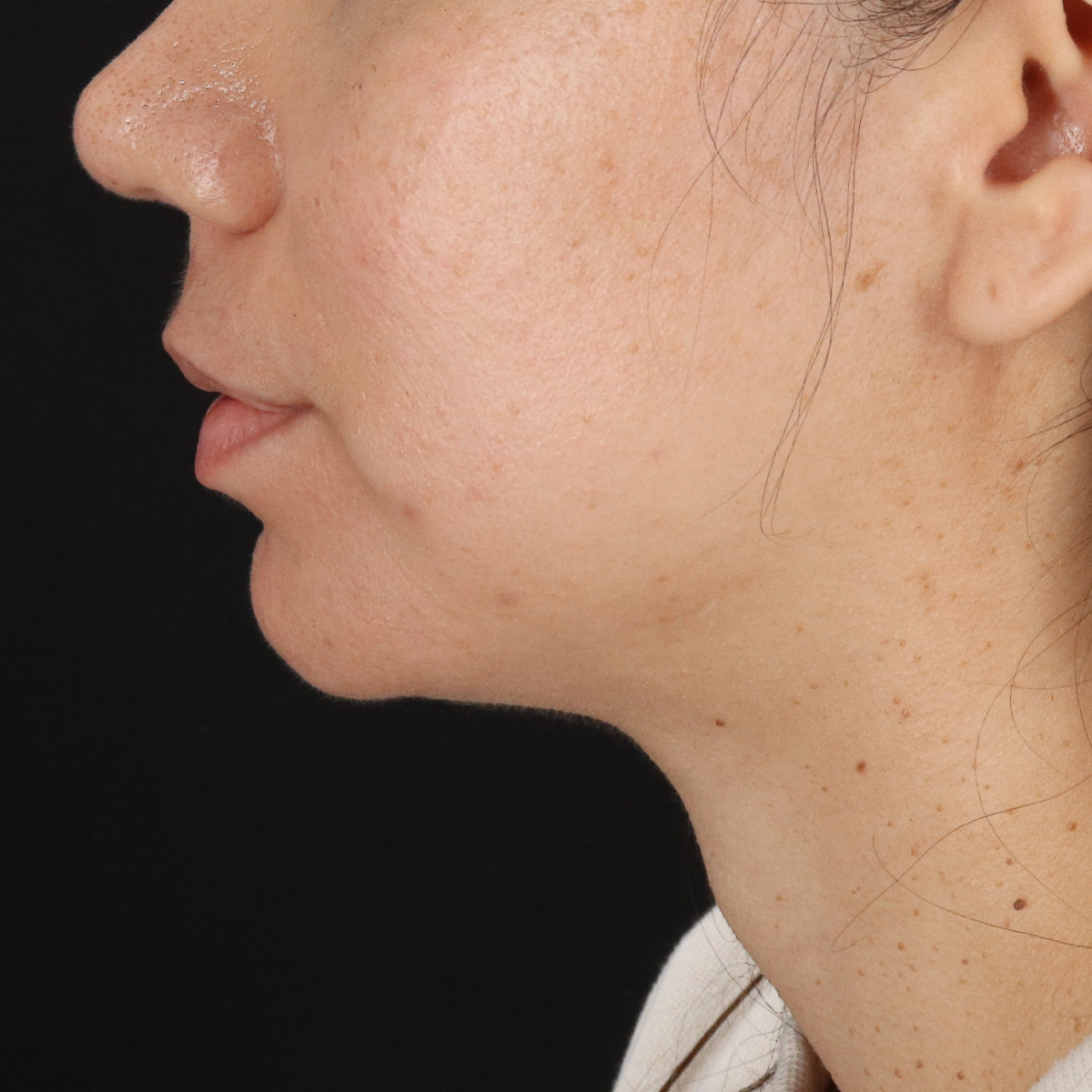 Neck Lift Before & After Patient #14047