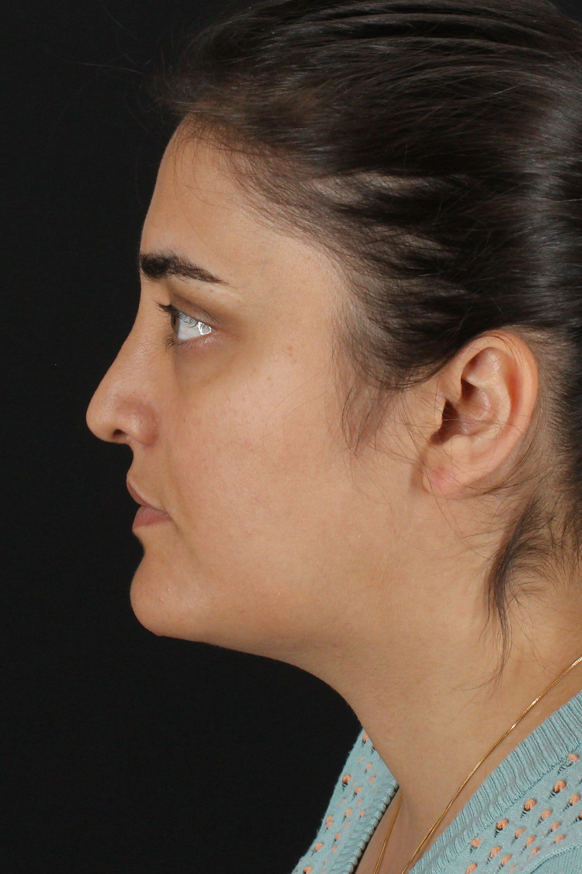 Neck Lift Before & After Patient #11565