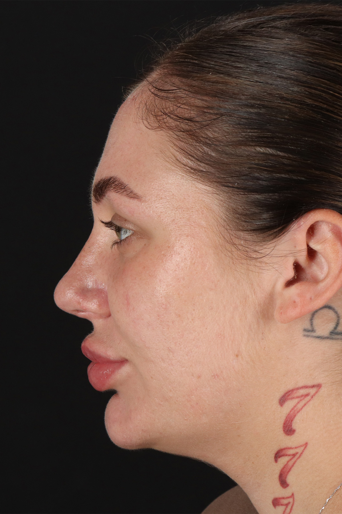 Rhinoplasty Before & After Patient #12403
