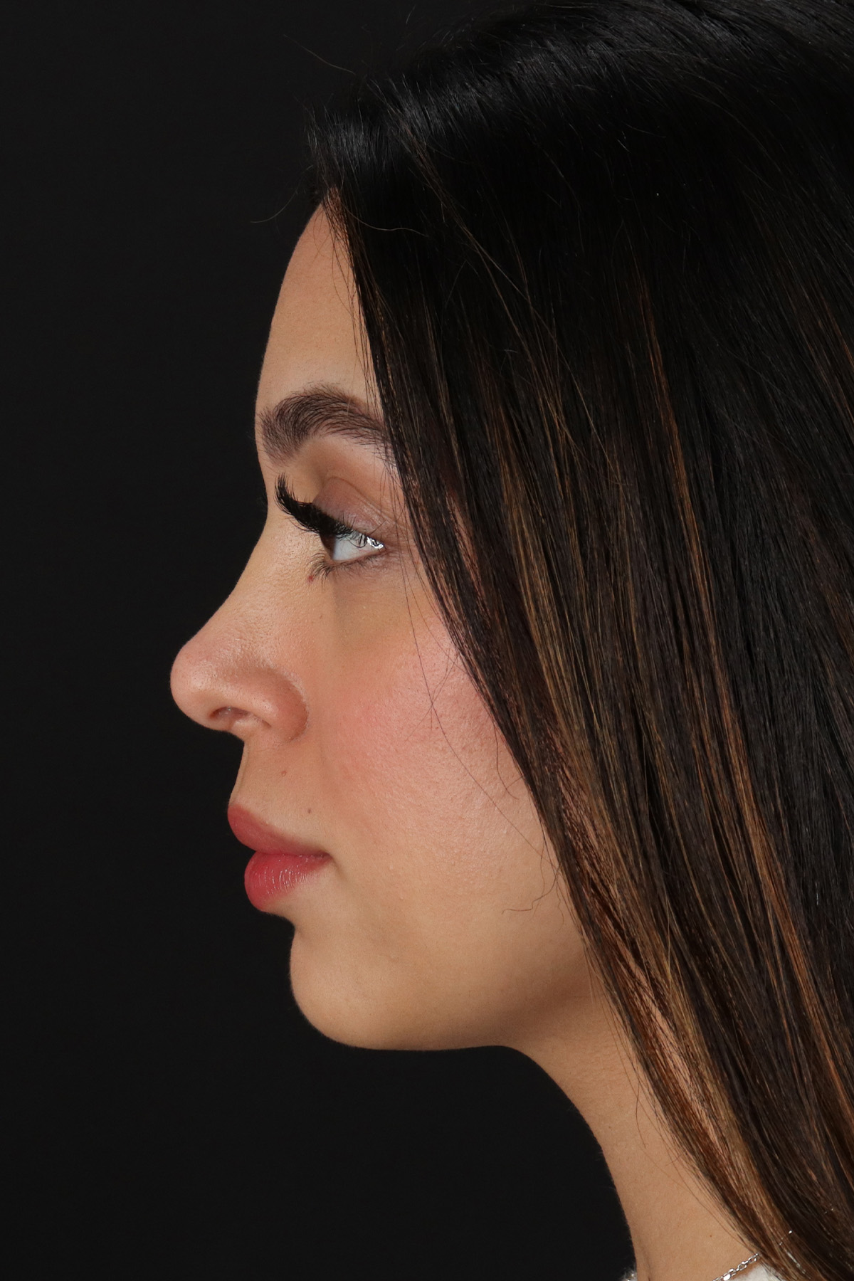 Rhinoplasty Before & After Patient #12249