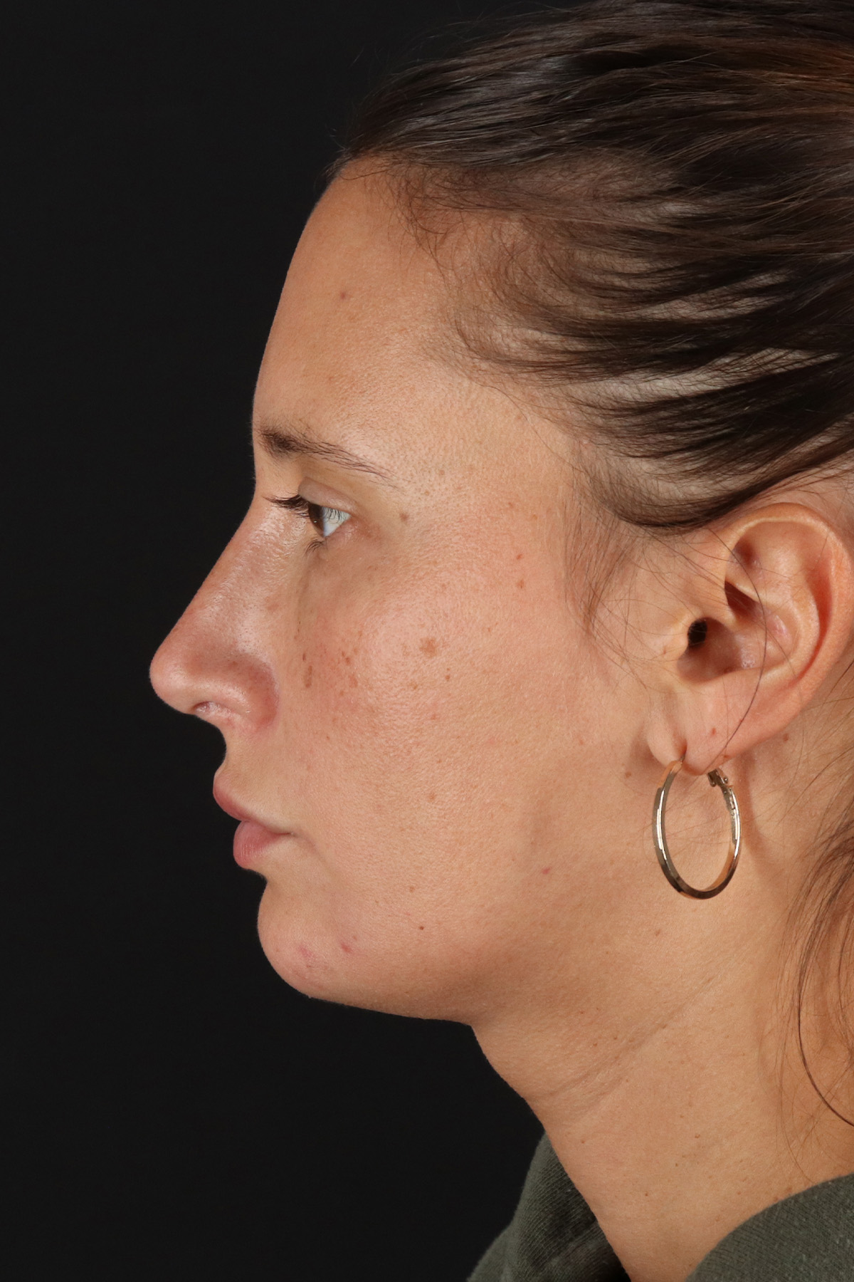 Chin Implant Before & After Patient #13728