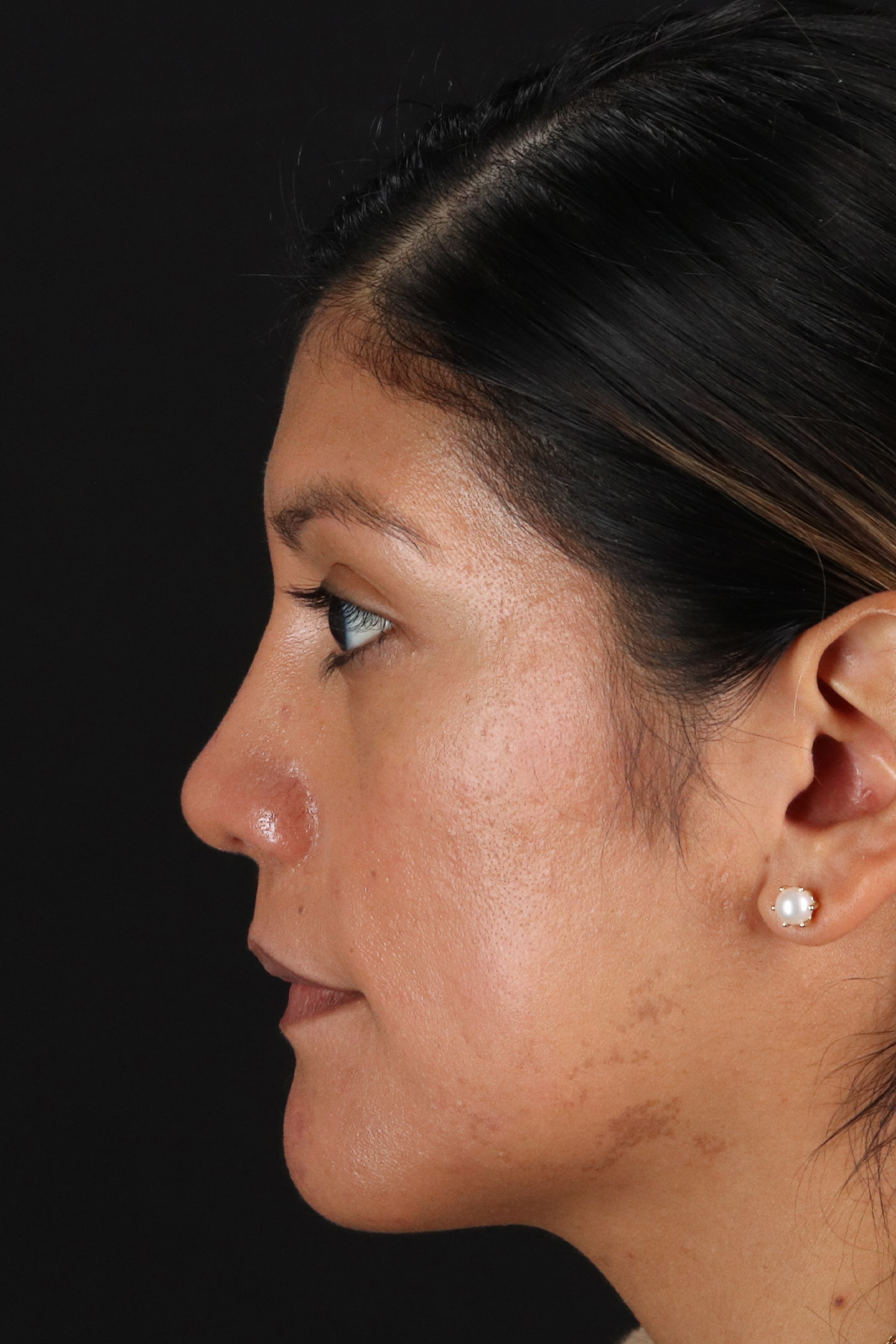 Rhinoplasty Before & After Patient #12337