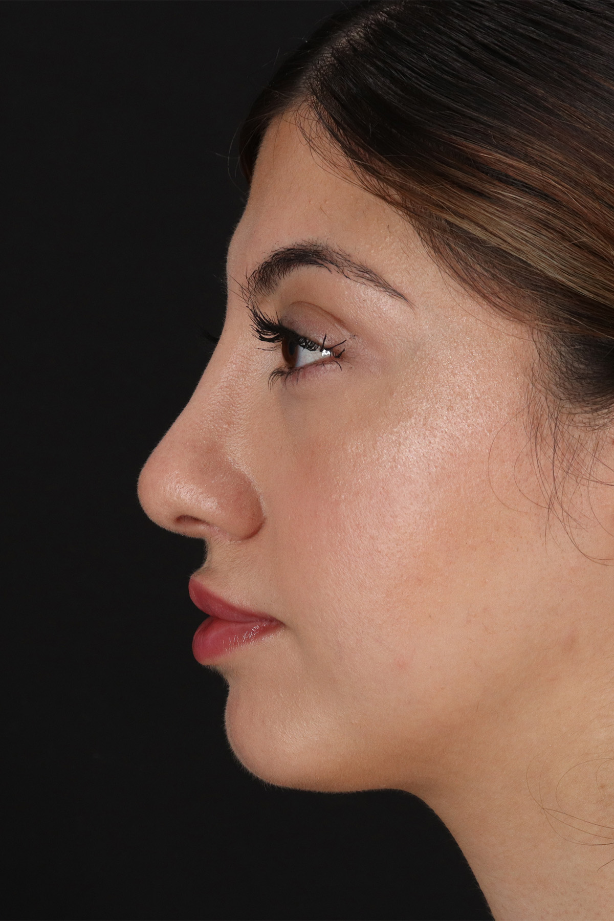Rhinoplasty Before & After Patient #12304