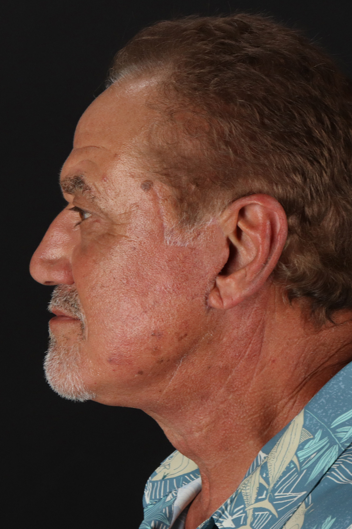 Lower Blepharoplasty Before & After Patient #13096