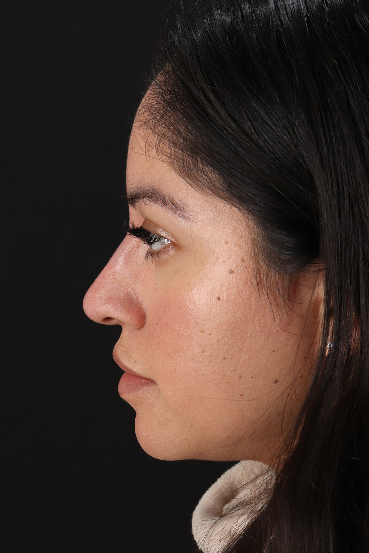 Fillers Before & After Patient #13276