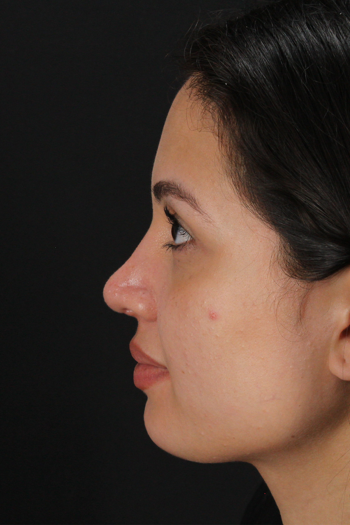 Rhinoplasty Before & After Patient #12282