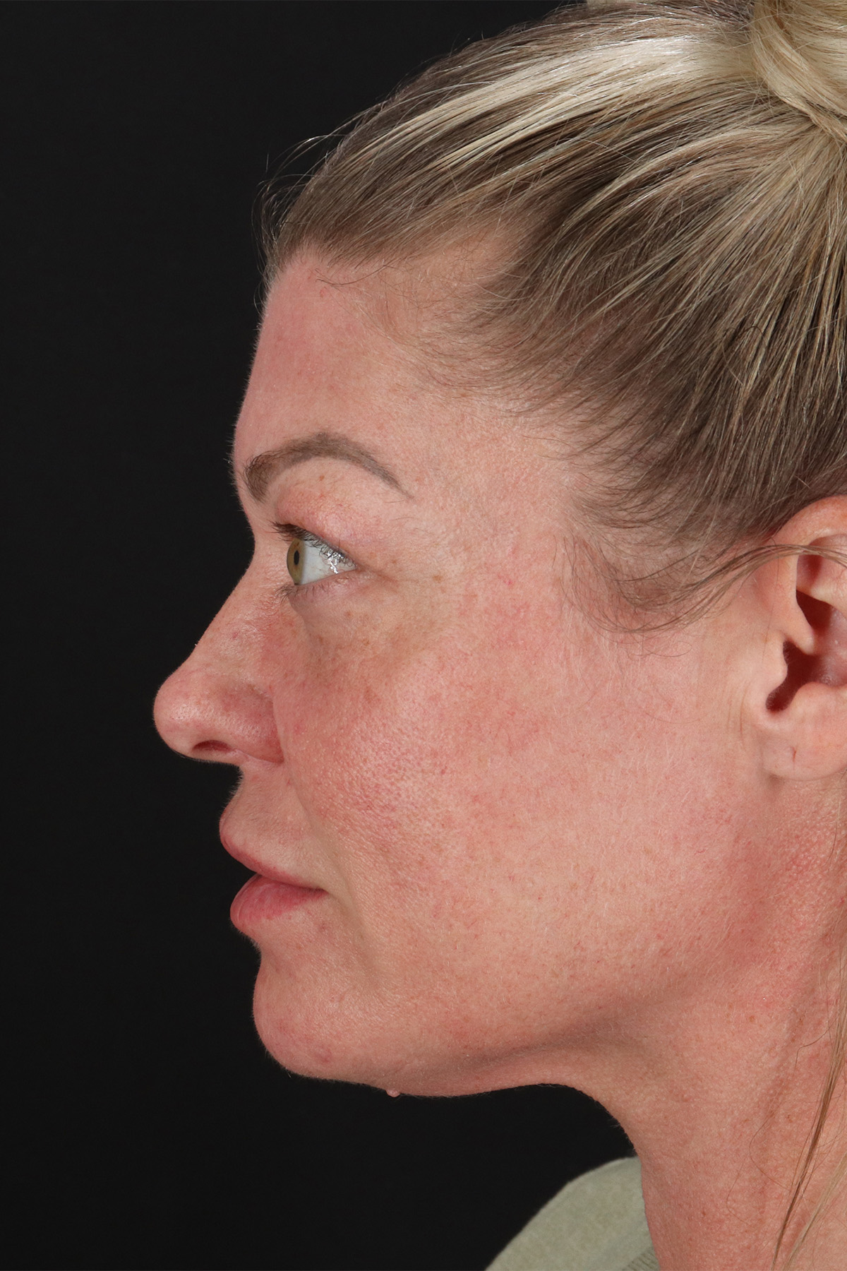 Lower Blepharoplasty Before & After Patient #13030