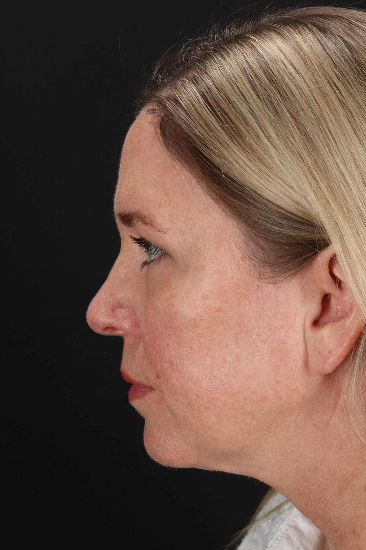 Upper Blepharoplasty Before & After Patient #12029