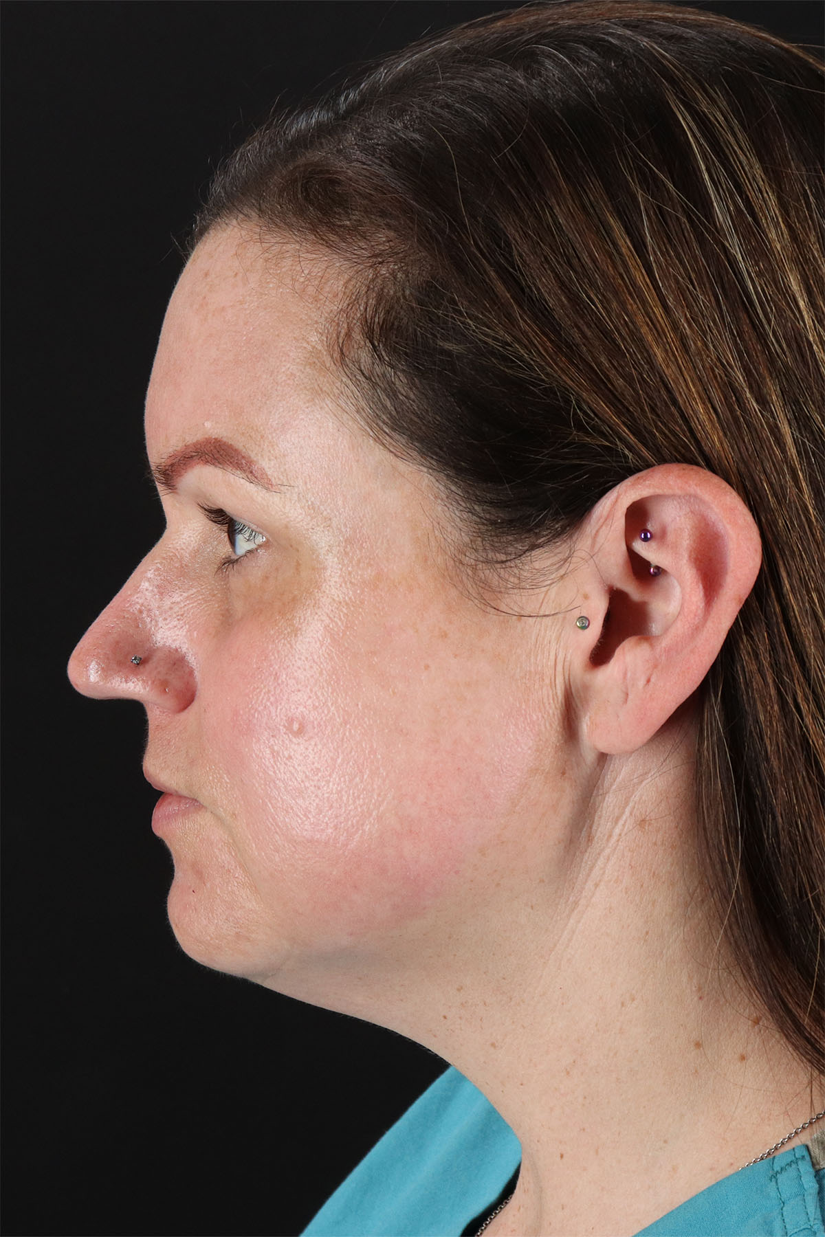 Chemical Peels Before & After Patient #11070