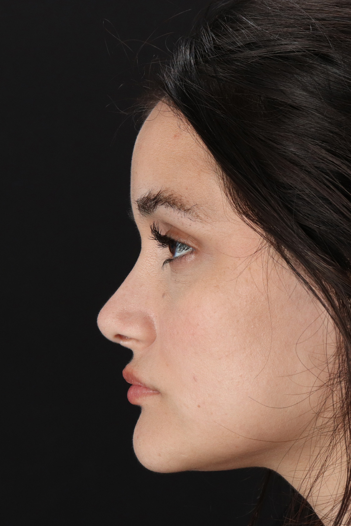 Rhinoplasty Before & After Patient #12260