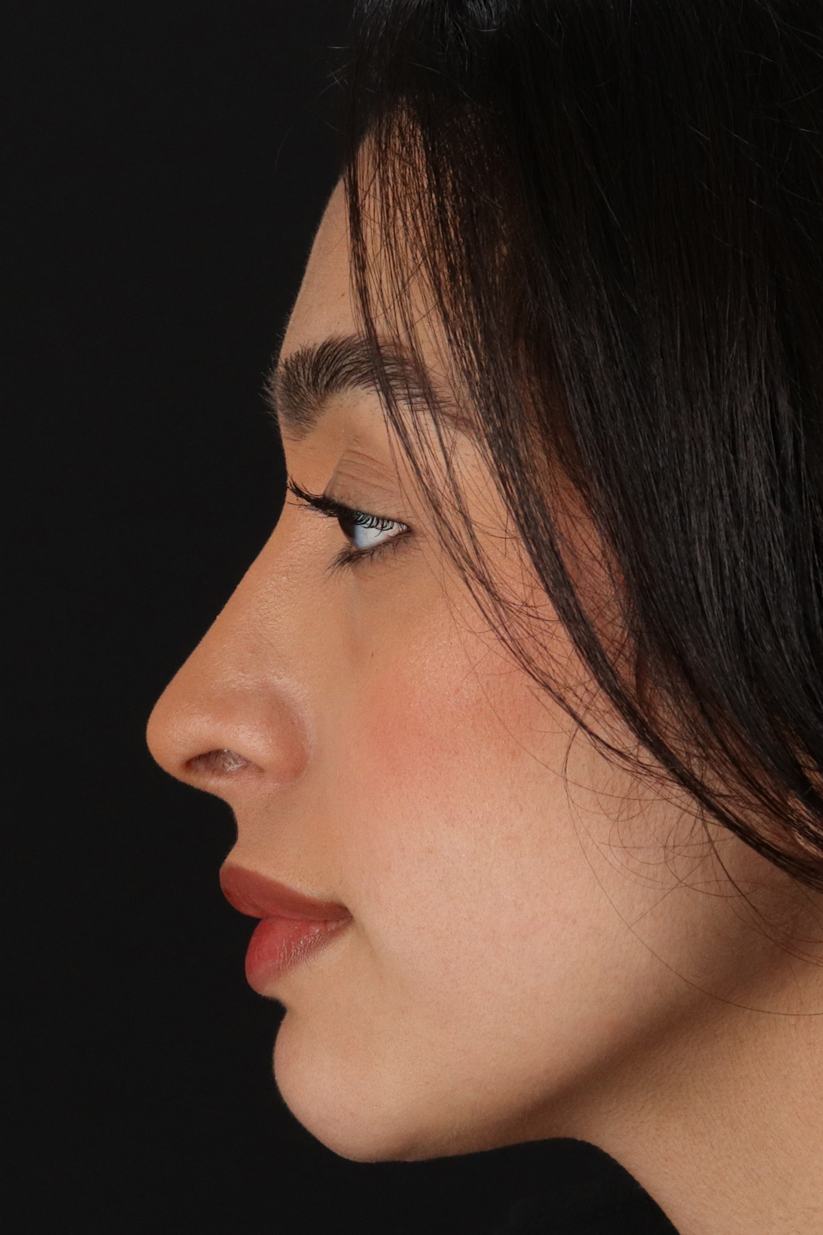 Chin Implant Before & After Patient #13706