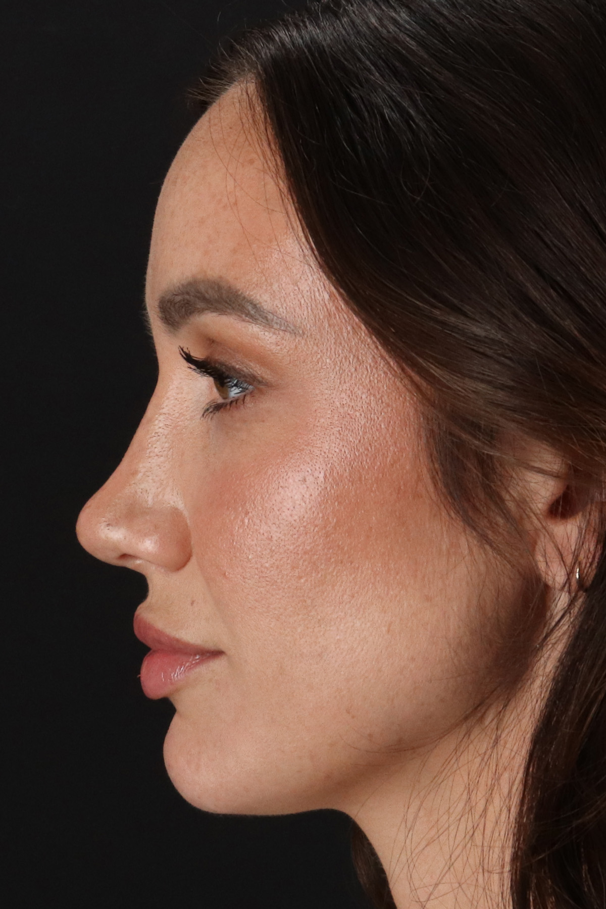 Rhinoplasty Before & After Patient #12370