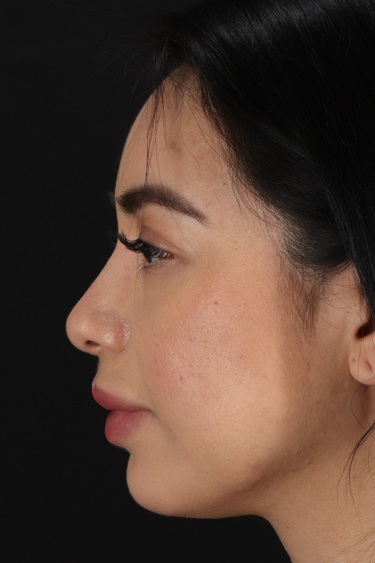 Chin Implant Before & After Patient #13717