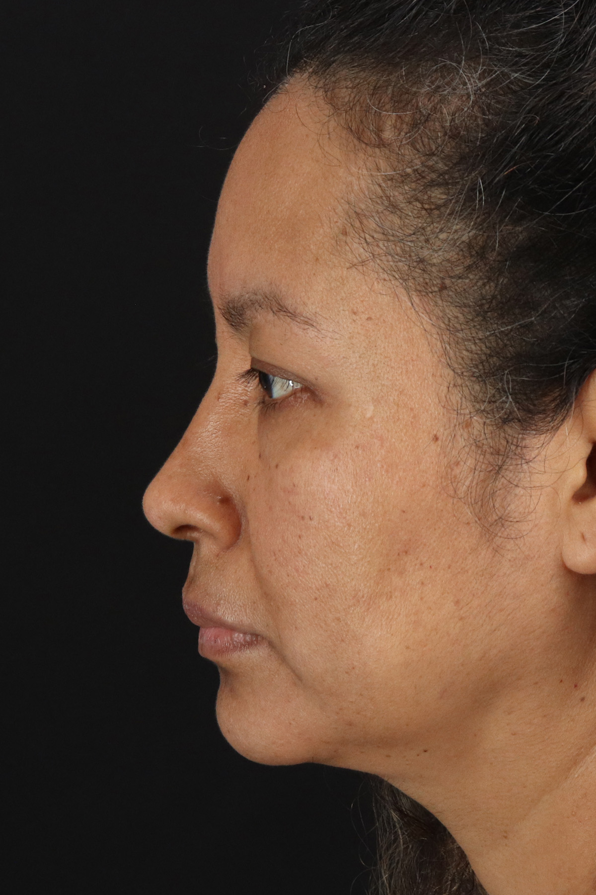 Rhinoplasty Before & After Patient #12293