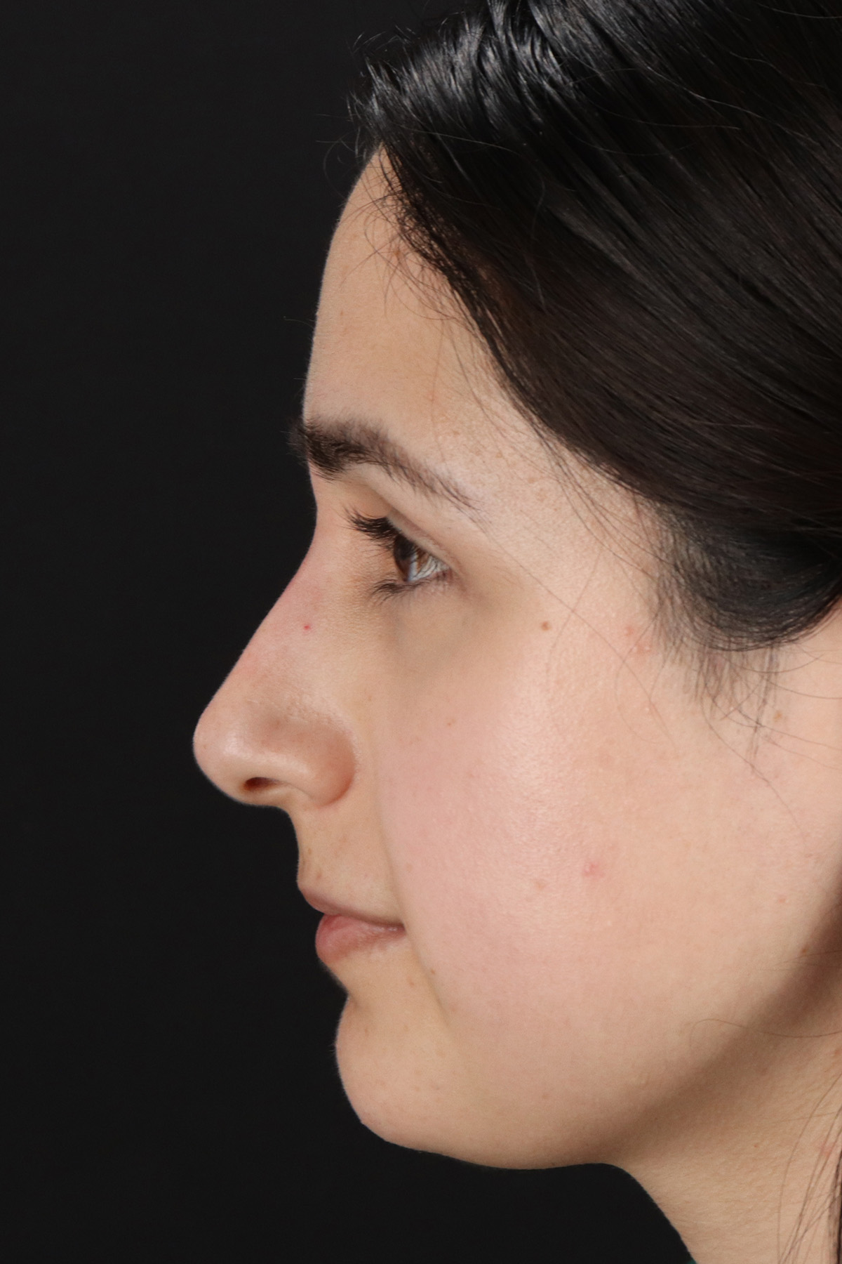 Liquid Rhinoplasty Before & After Patient #11339