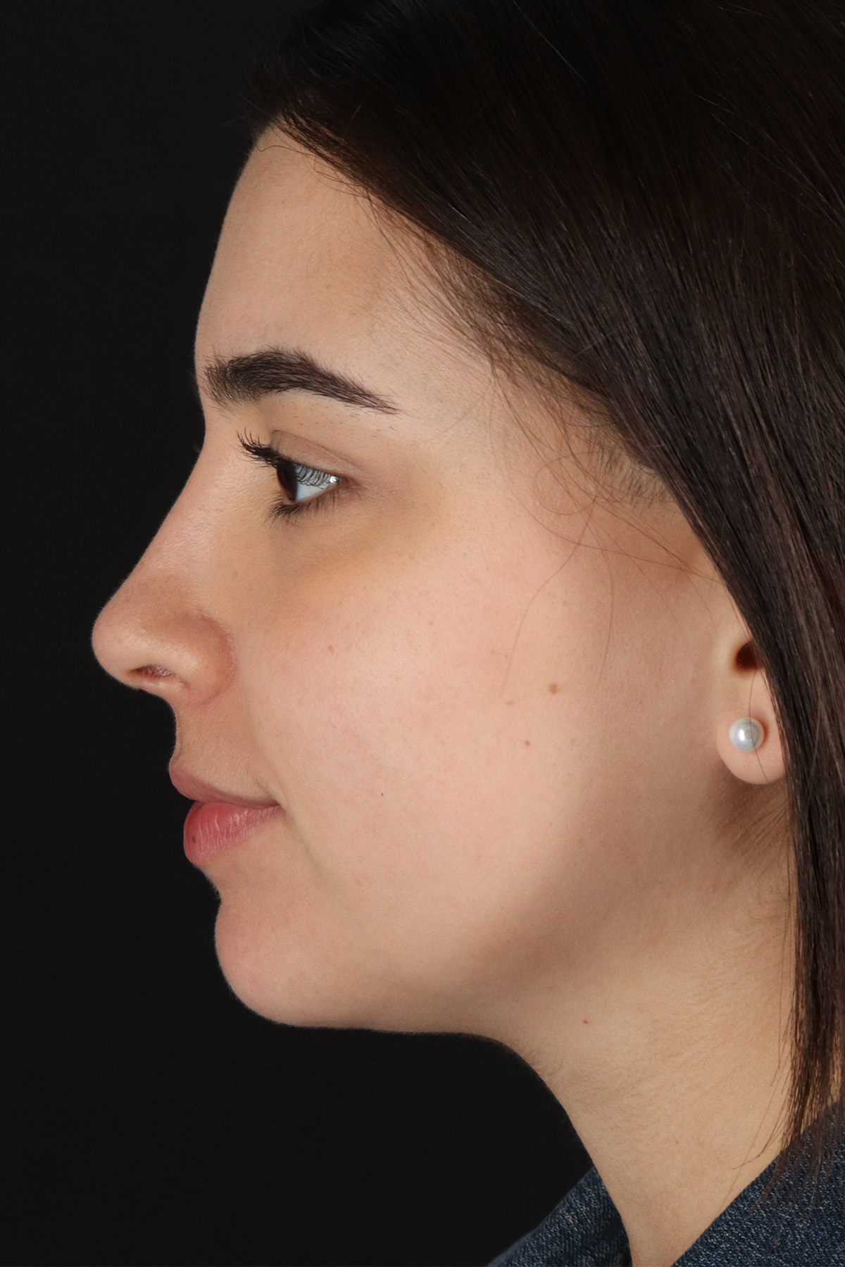 Chin Implant Before & After Patient #11694