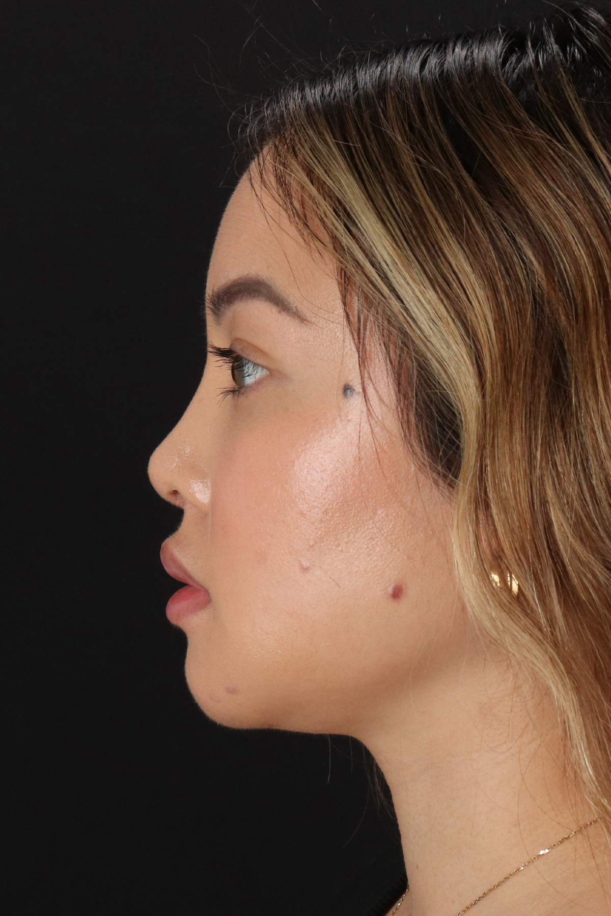 Chin Implant Before & After Patient #13816