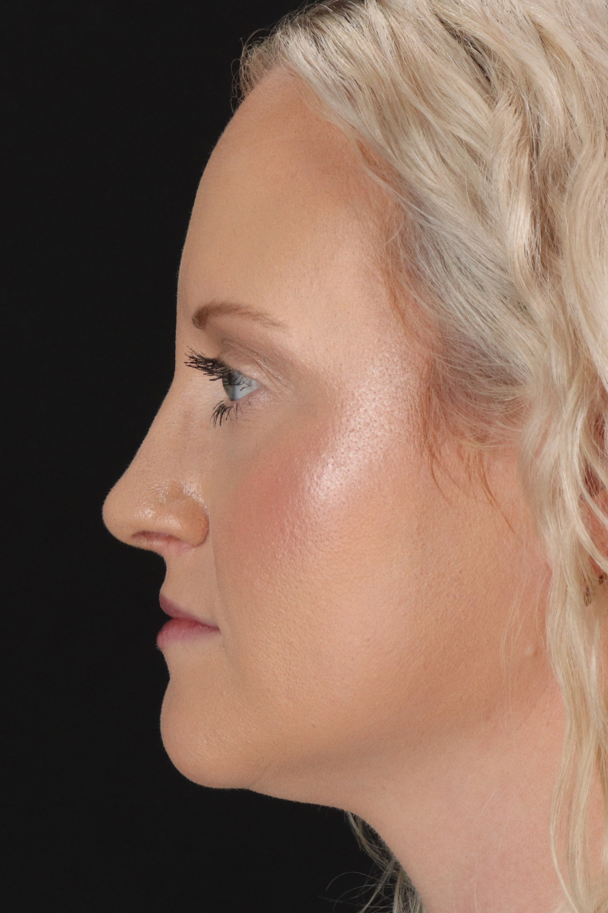Rhinoplasty Before & After Patient #12381