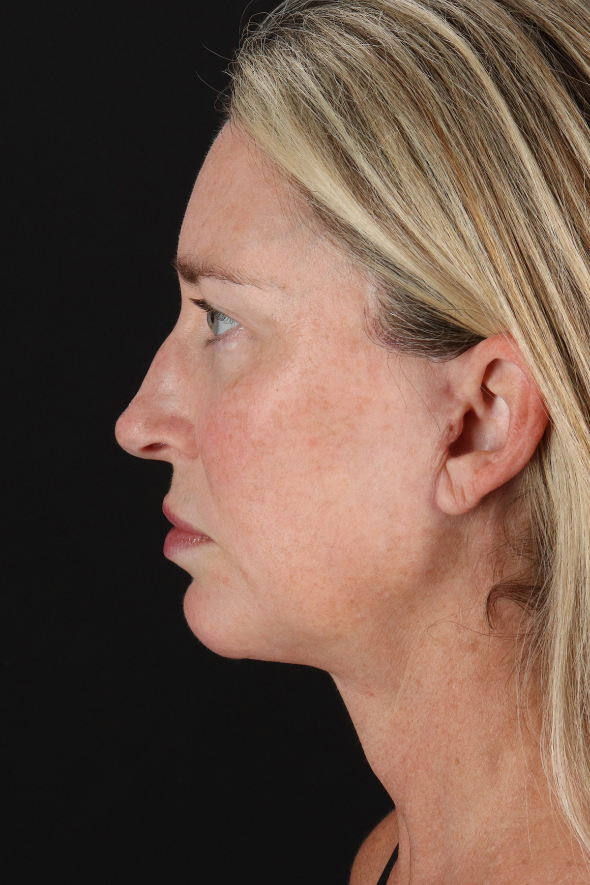 Upper Blepharoplasty Before & After Patient #12084