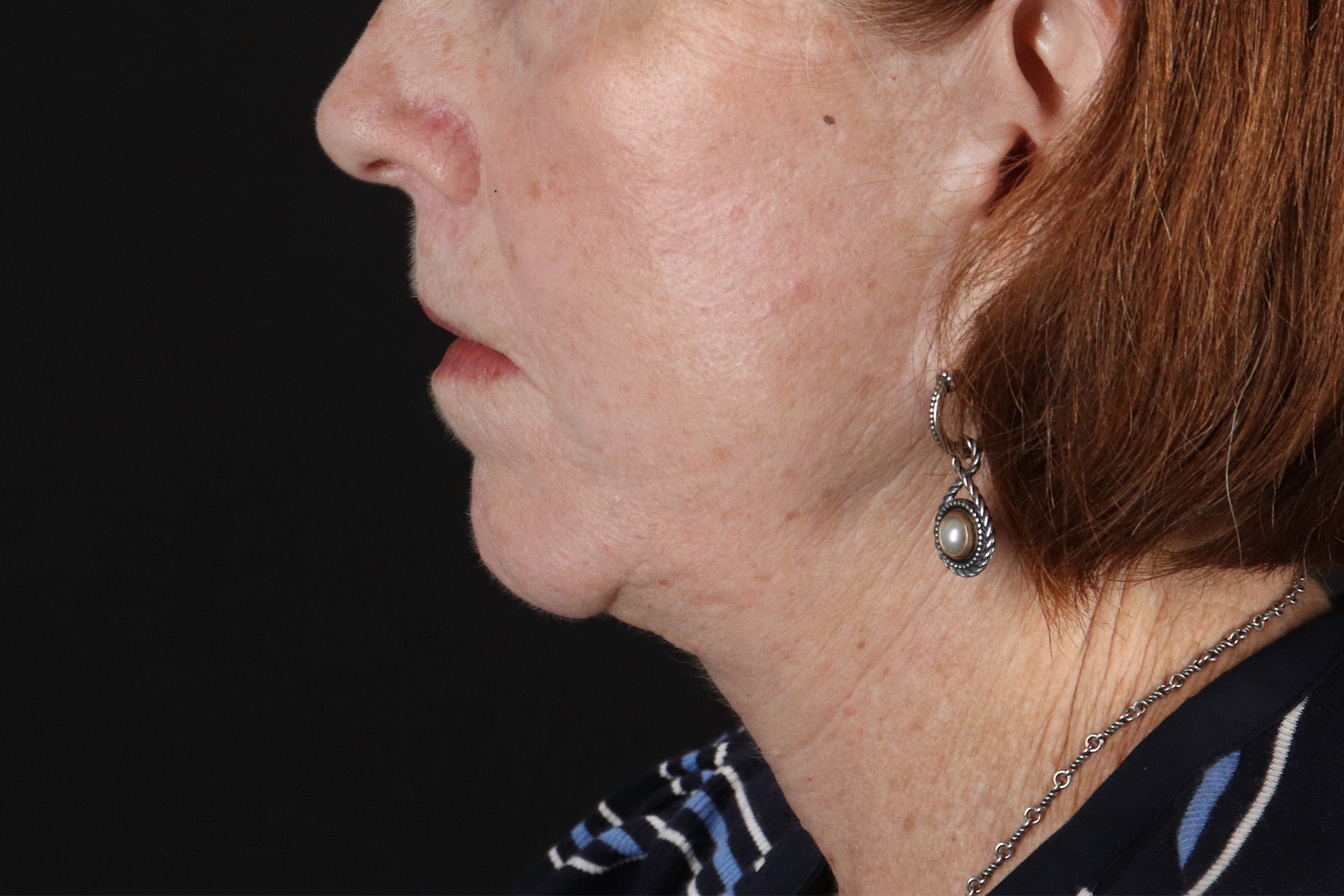 Neck Liposuction Before & After Patient #12117