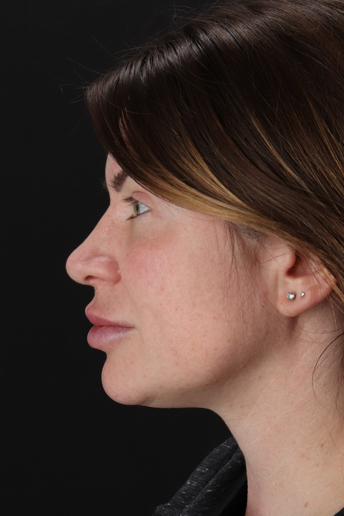 Rhinoplasty Before & After Patient #12414
