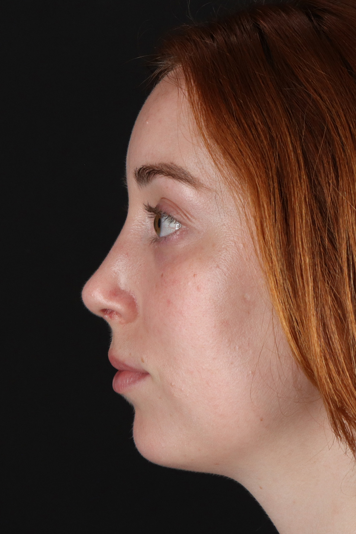 Rhinoplasty Before & After Patient #12348