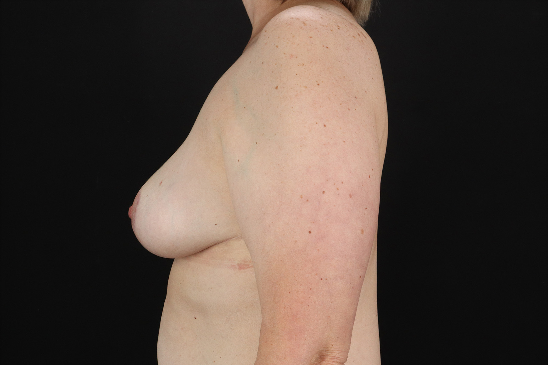 Breast Lift Before & After Patient #11092