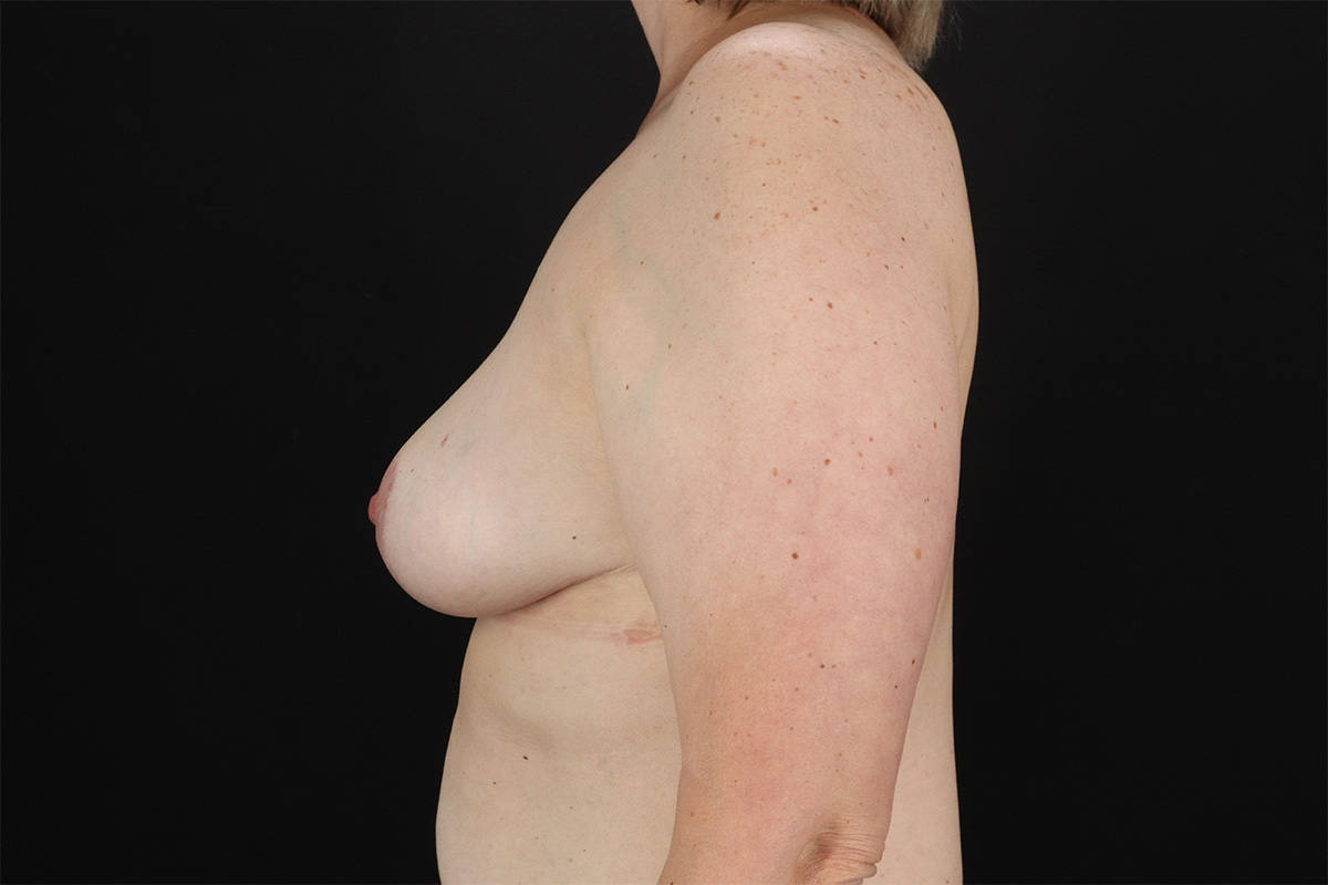 Breast Reduction With Lift Before & After Patient #10969