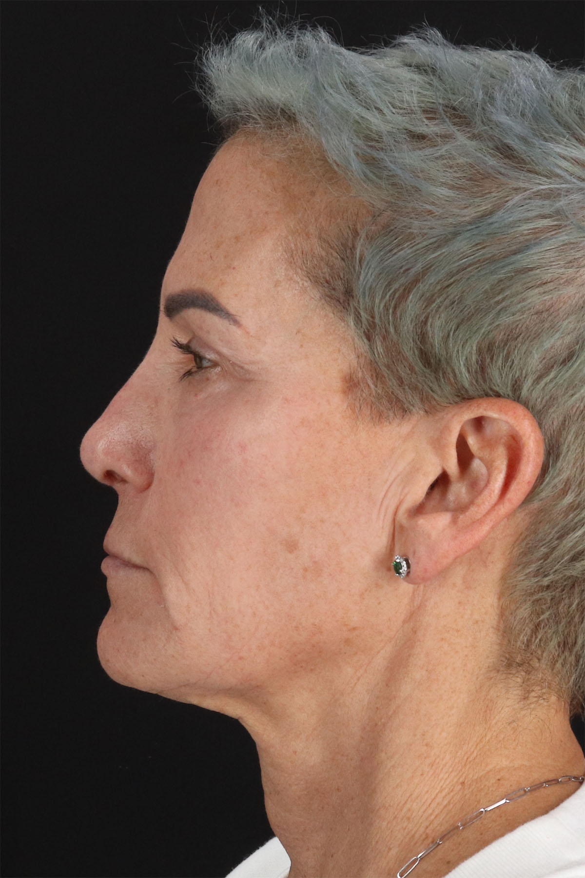 CO2 Laser Before & After Patient #10980