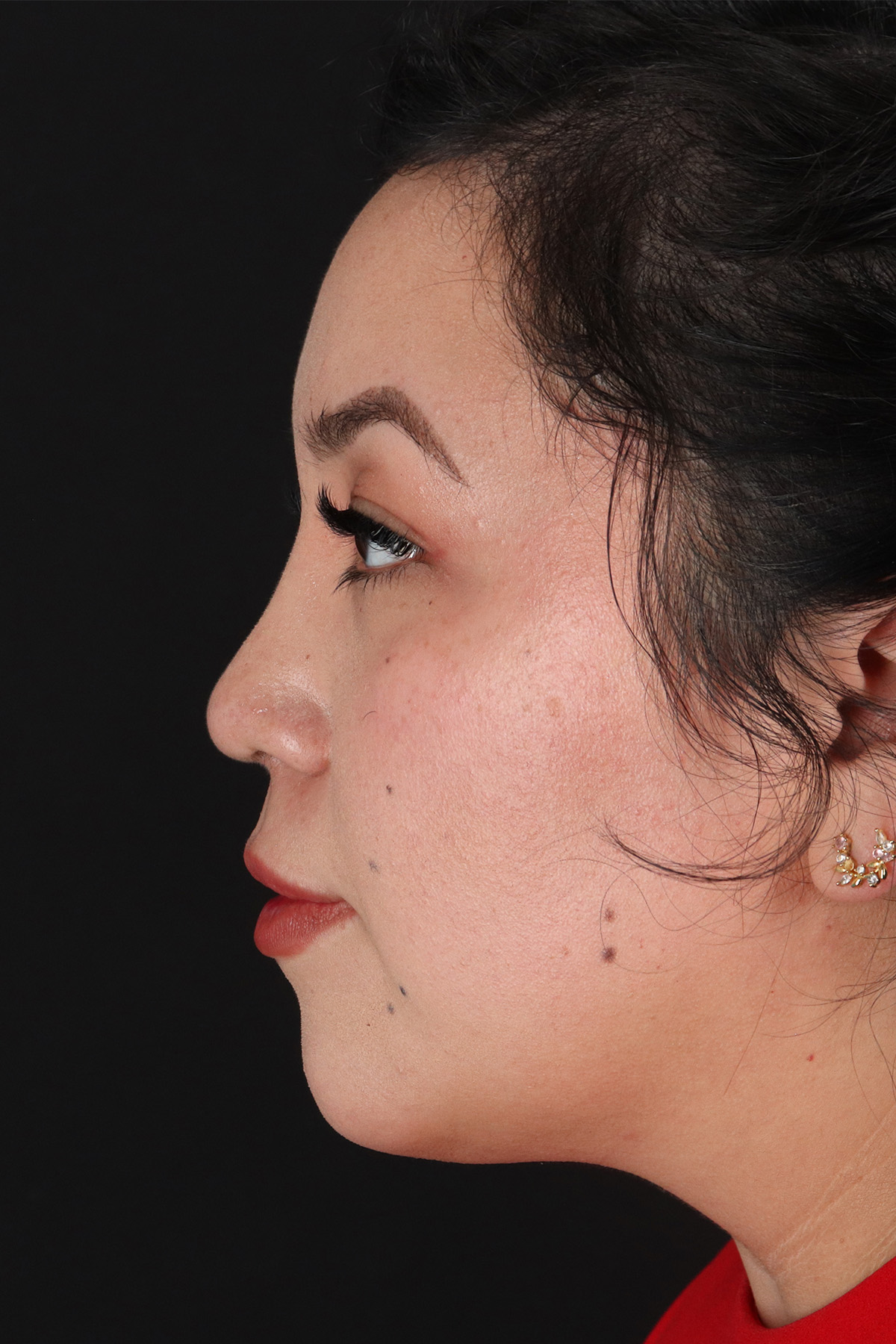 Rhinoplasty Before & After Patient #12447