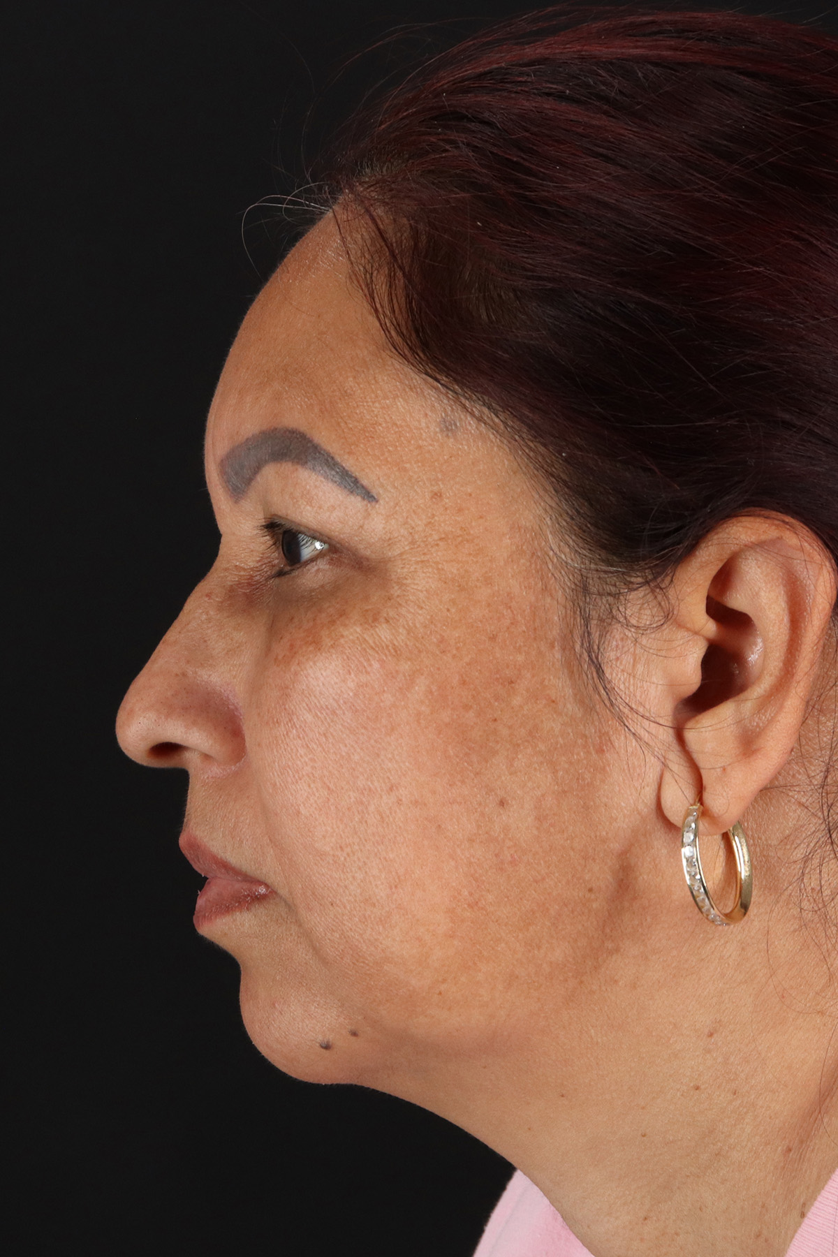 Lower Blepharoplasty Before & After Patient #13085