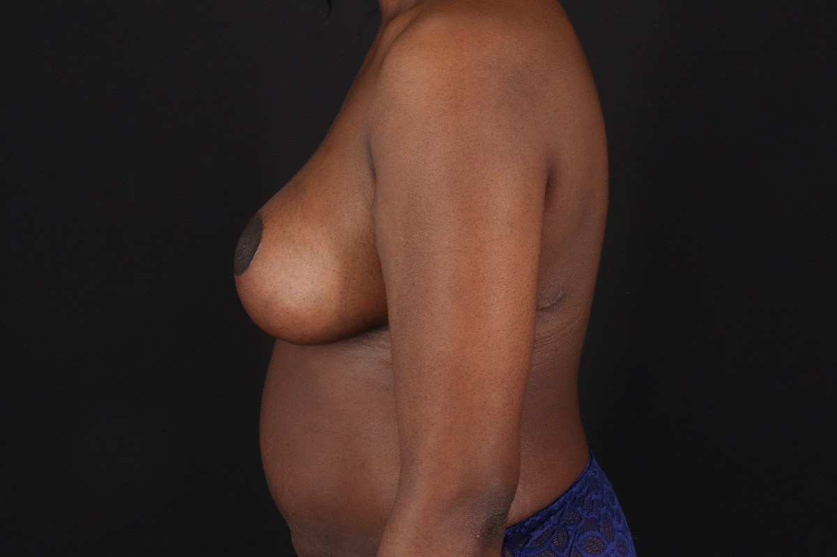 Breast Reduction With Lift Before & After Patient #11440